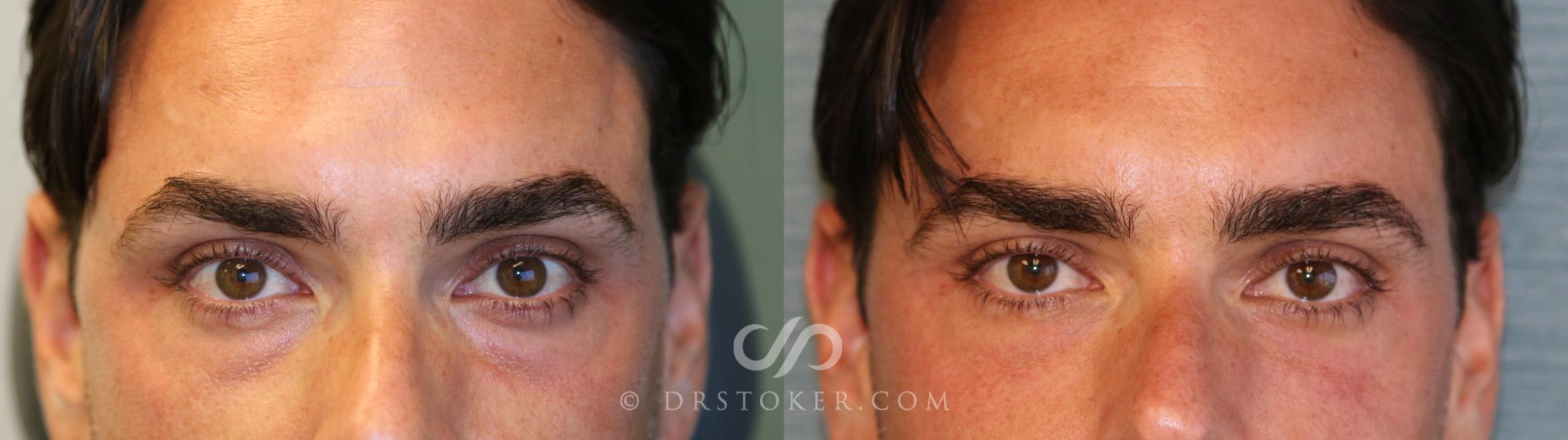 Before & After Facial Fillers Case 1596 View #1 View in Marina del Rey, CA