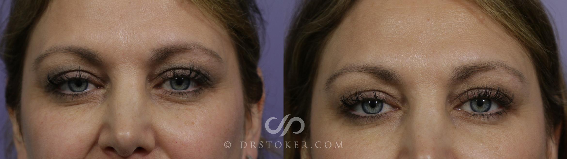 Before & After Undereye Fillers Case 1624 View #1 View in Marina del Rey, CA