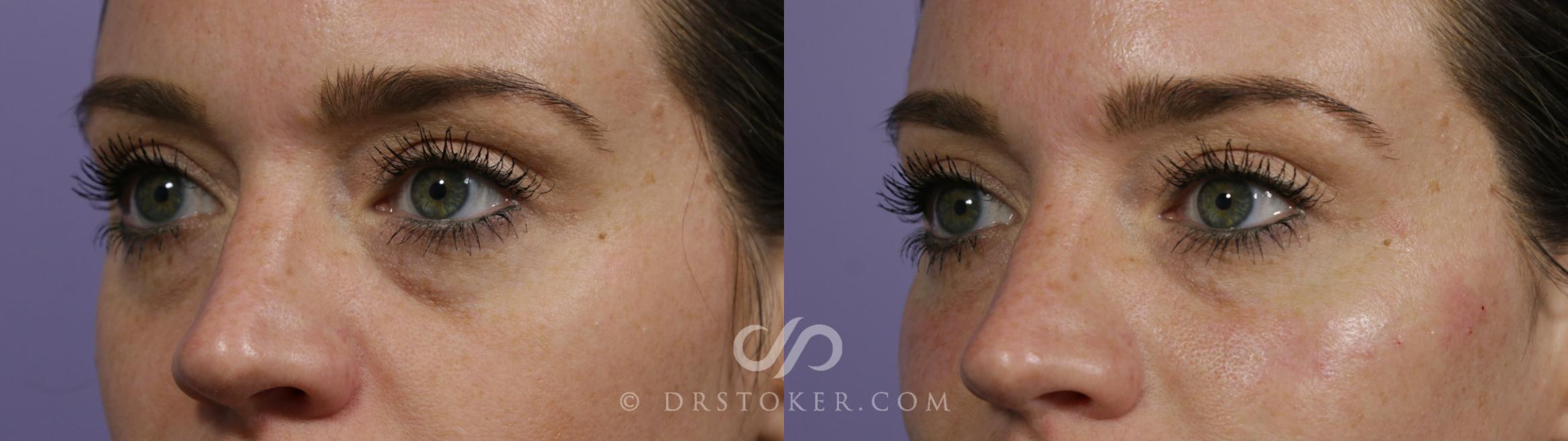 Before & After Undereye Fillers Case 1648 View #1 View in Marina del Rey, CA