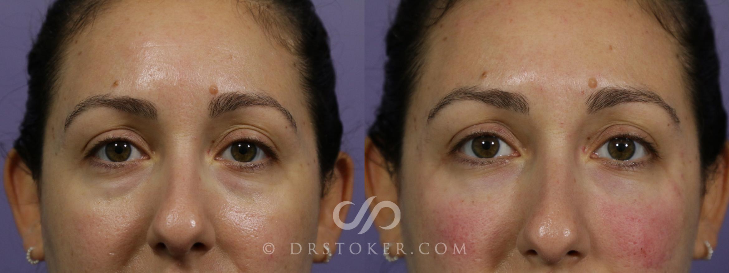 Before & After Undereye Fillers Case 1655 View #1 View in Los Angeles, CA