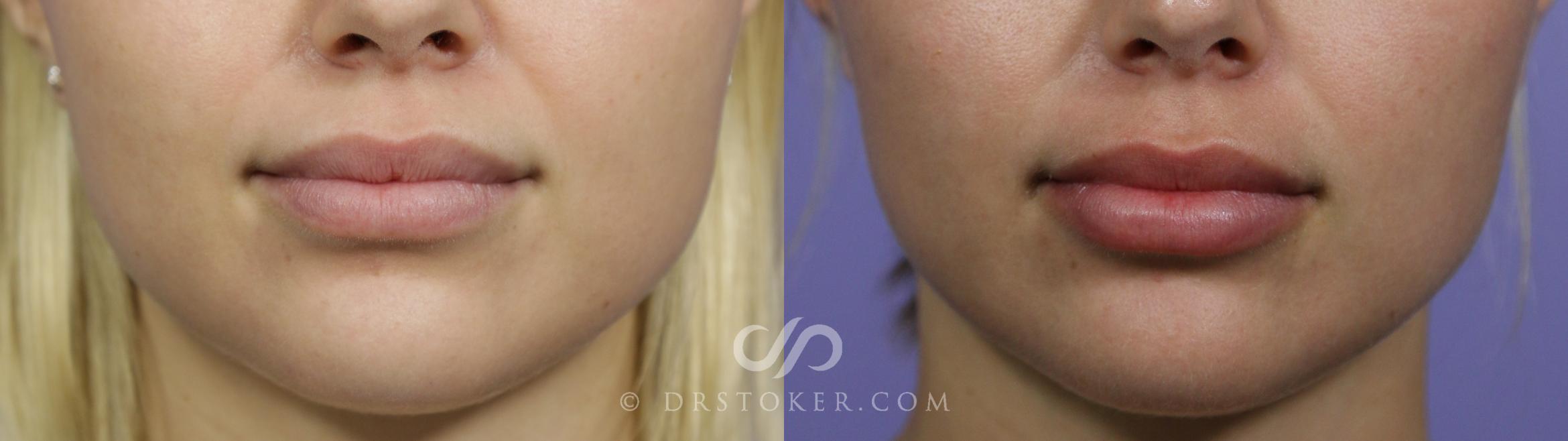 Before & After Lip Fillers/Augmentation Case 1581 View #1 View in Marina del Rey, CA