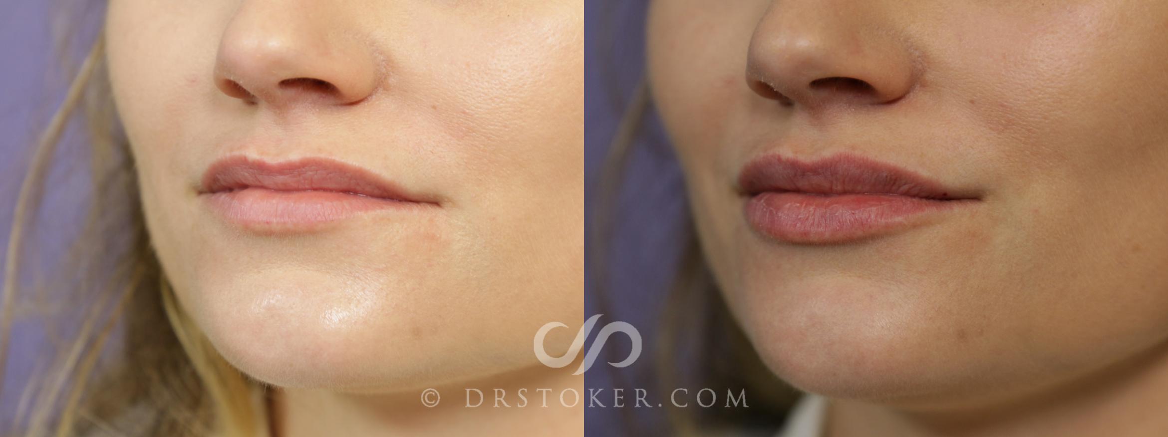 Before & After Lip Fillers/Augmentation Case 1582 View #1 View in Marina del Rey, CA
