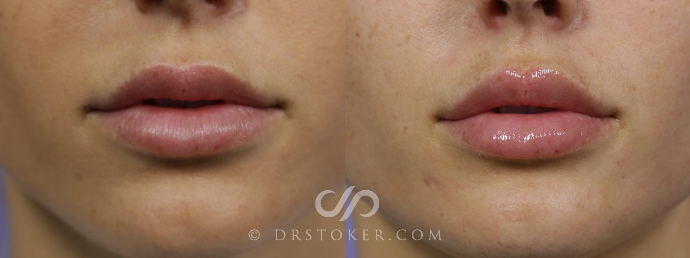 Dermal Fillers Los Angeles
