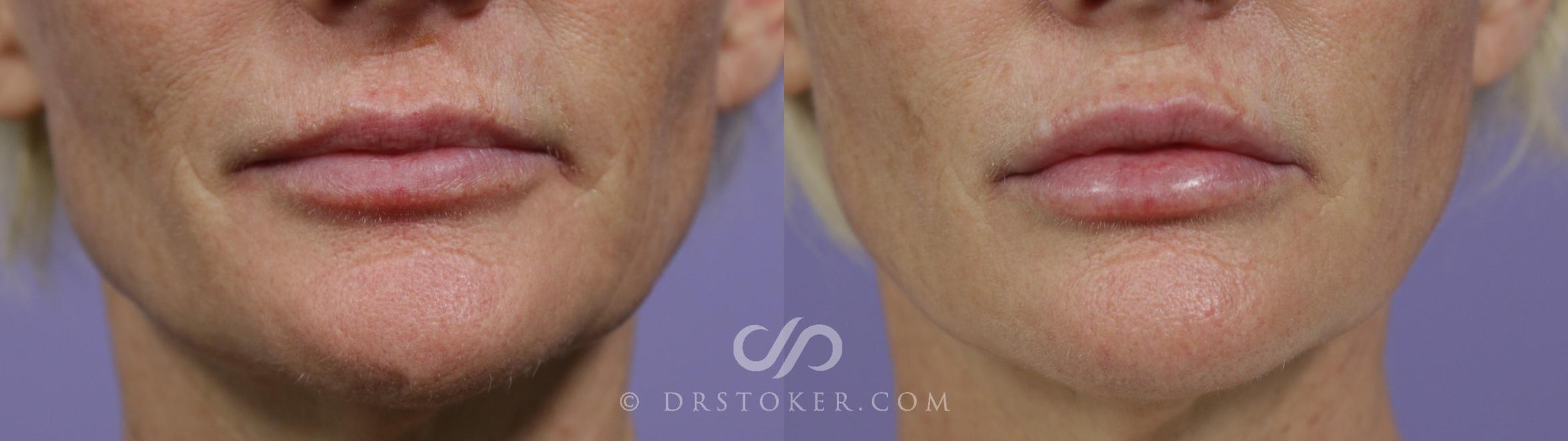 Before & After Lip Fillers/Augmentation Case 1606 View #1 View in Marina del Rey, CA