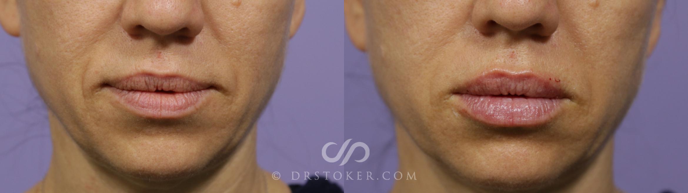 Before & After Lip Fillers/Augmentation Case 1623 View #1 View in Marina del Rey, CA
