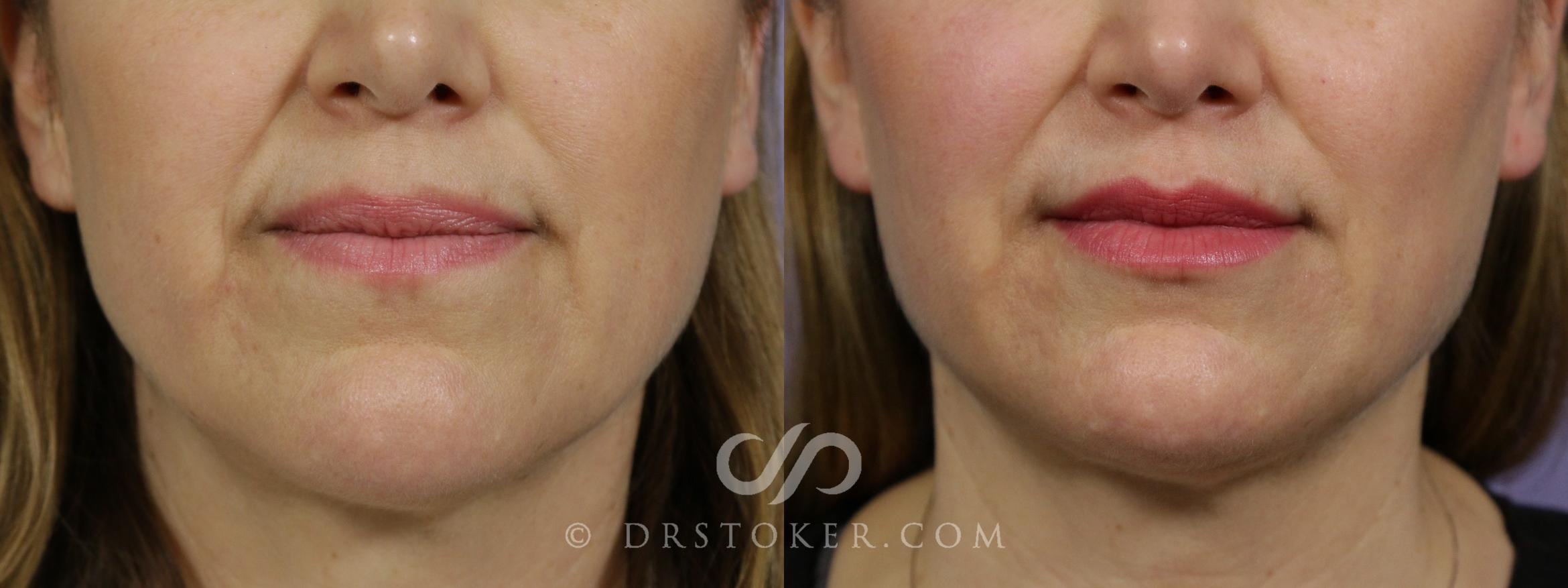 Before & After Lip Fillers/Augmentation Case 1649 View #1 View in Marina del Rey, CA