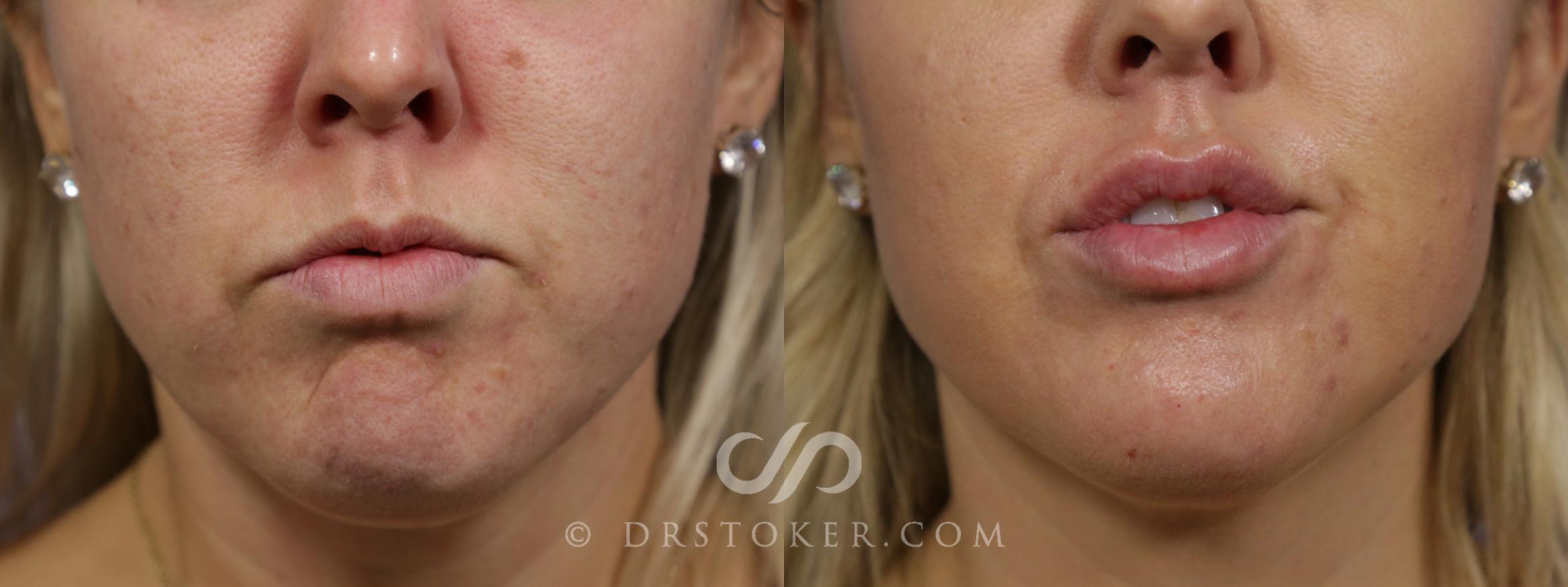 Before & After Lip Fillers/Augmentation Case 1654 View #1 View in Marina del Rey, CA