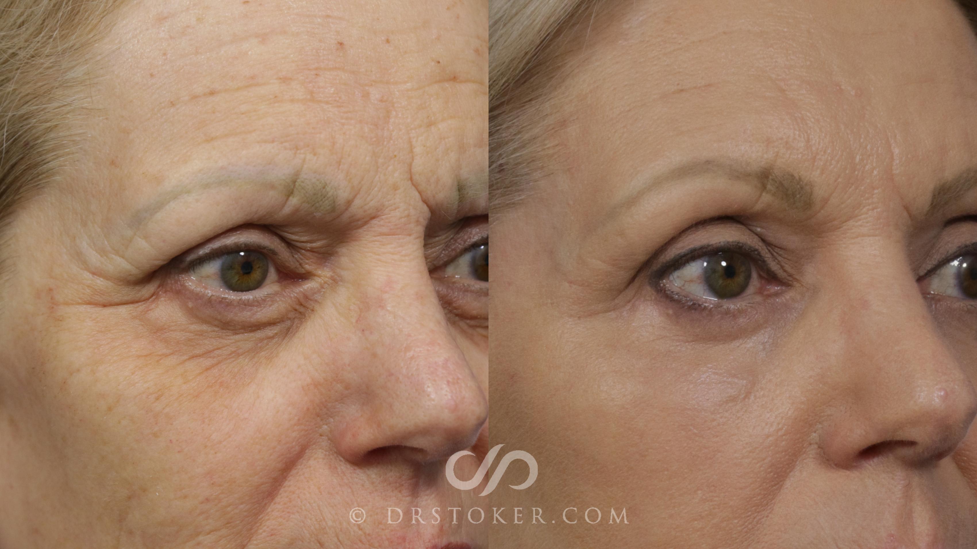 Before & After Brow Lift Case 2282 Right Oblique View in Los Angeles, CA