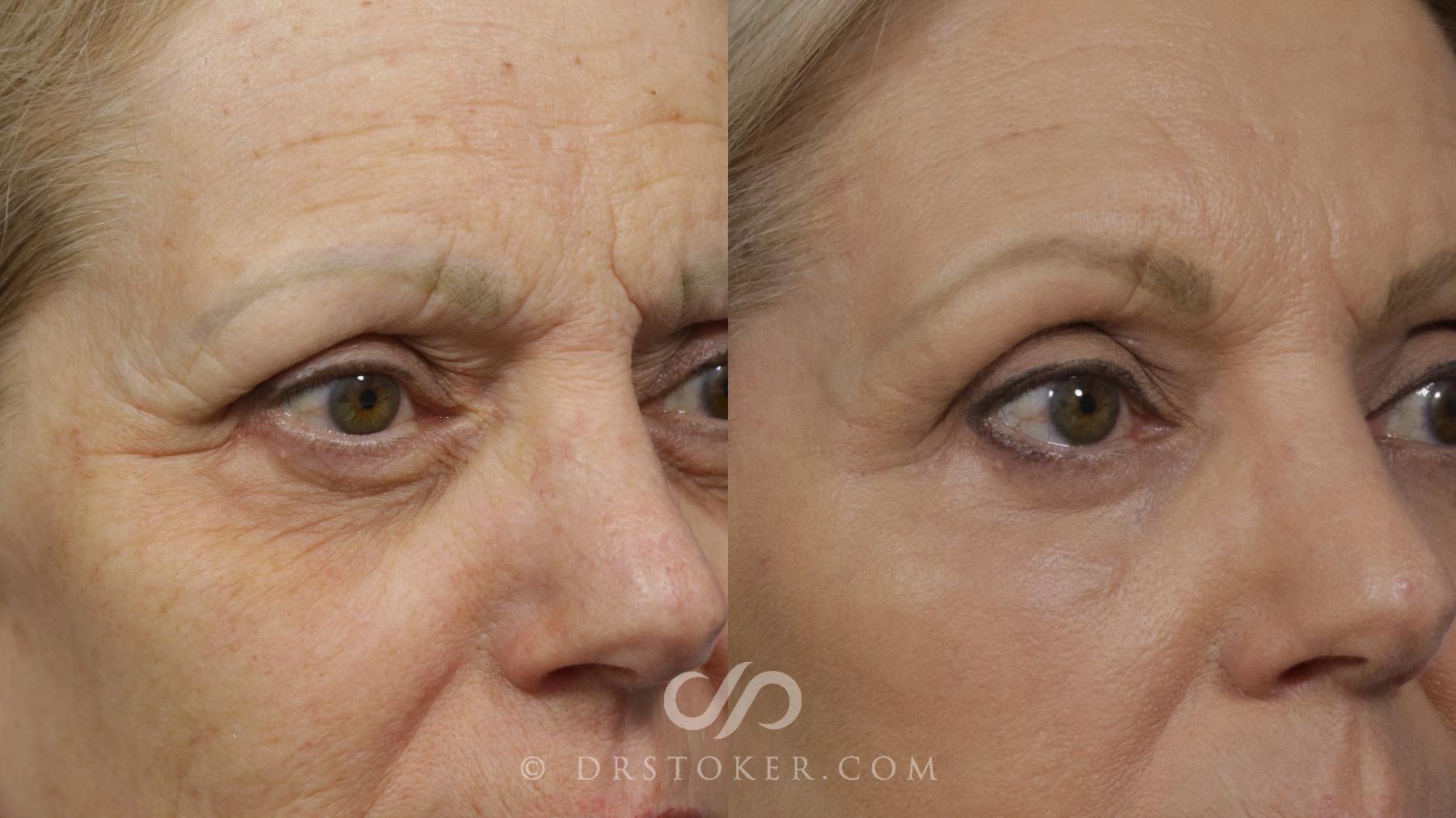 Before & After Brow Lift Case 2282 Right Oblique View in Los Angeles, CA