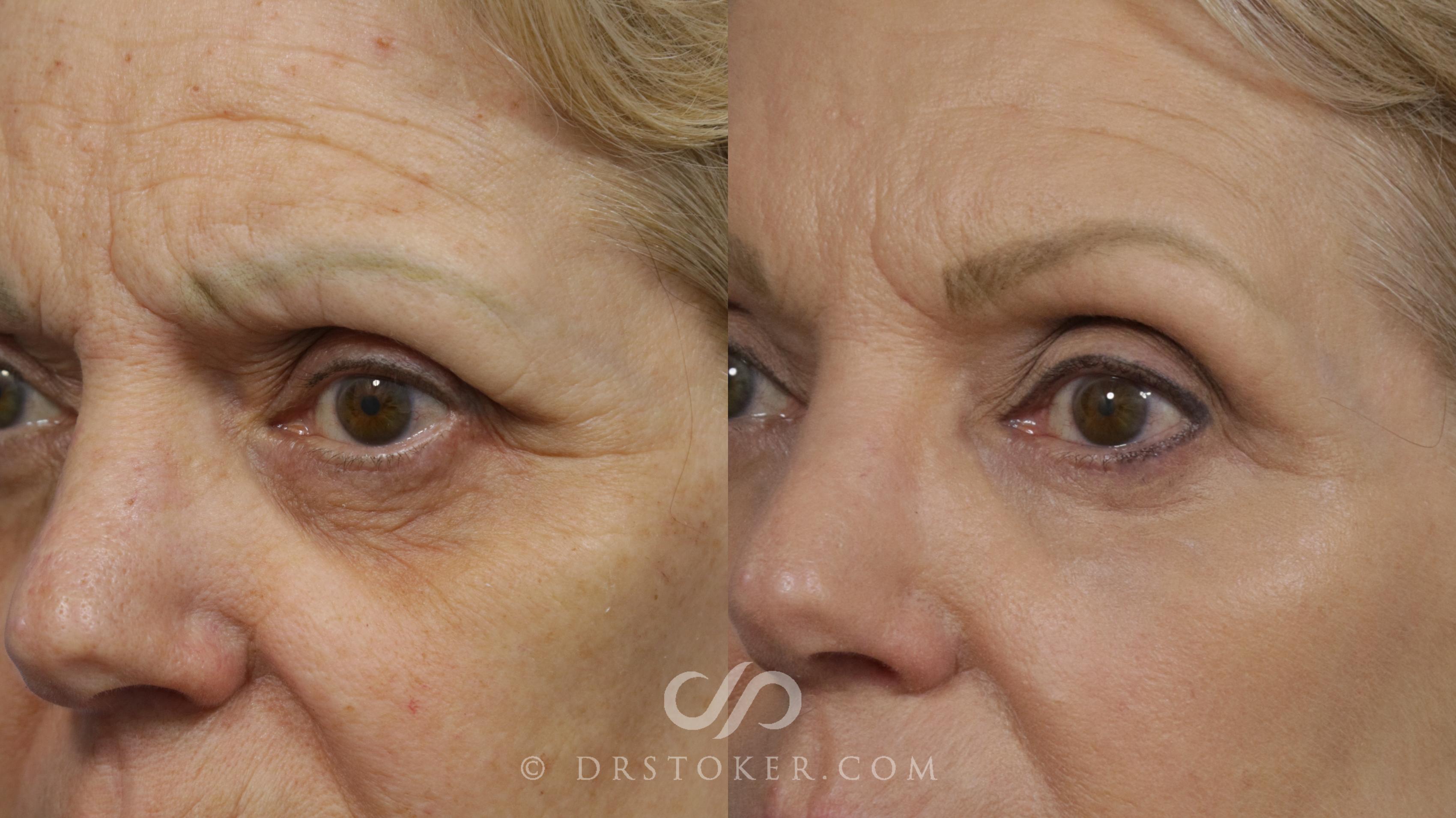 Before & After Brow Lift Case 2283 Left Oblique View in Los Angeles, CA