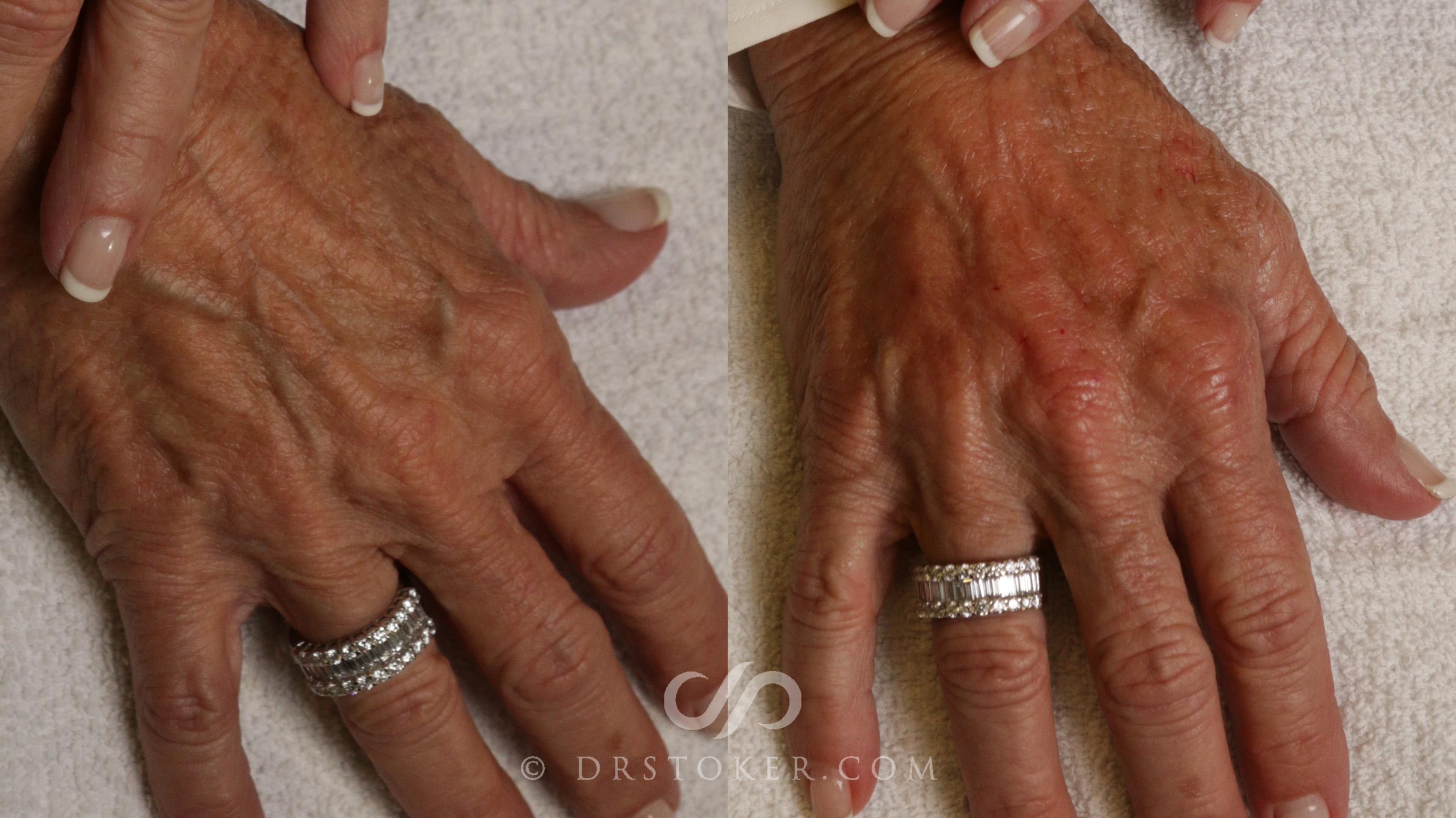 Before & After Hand Fillers Case 2275 Back View in Los Angeles, CA