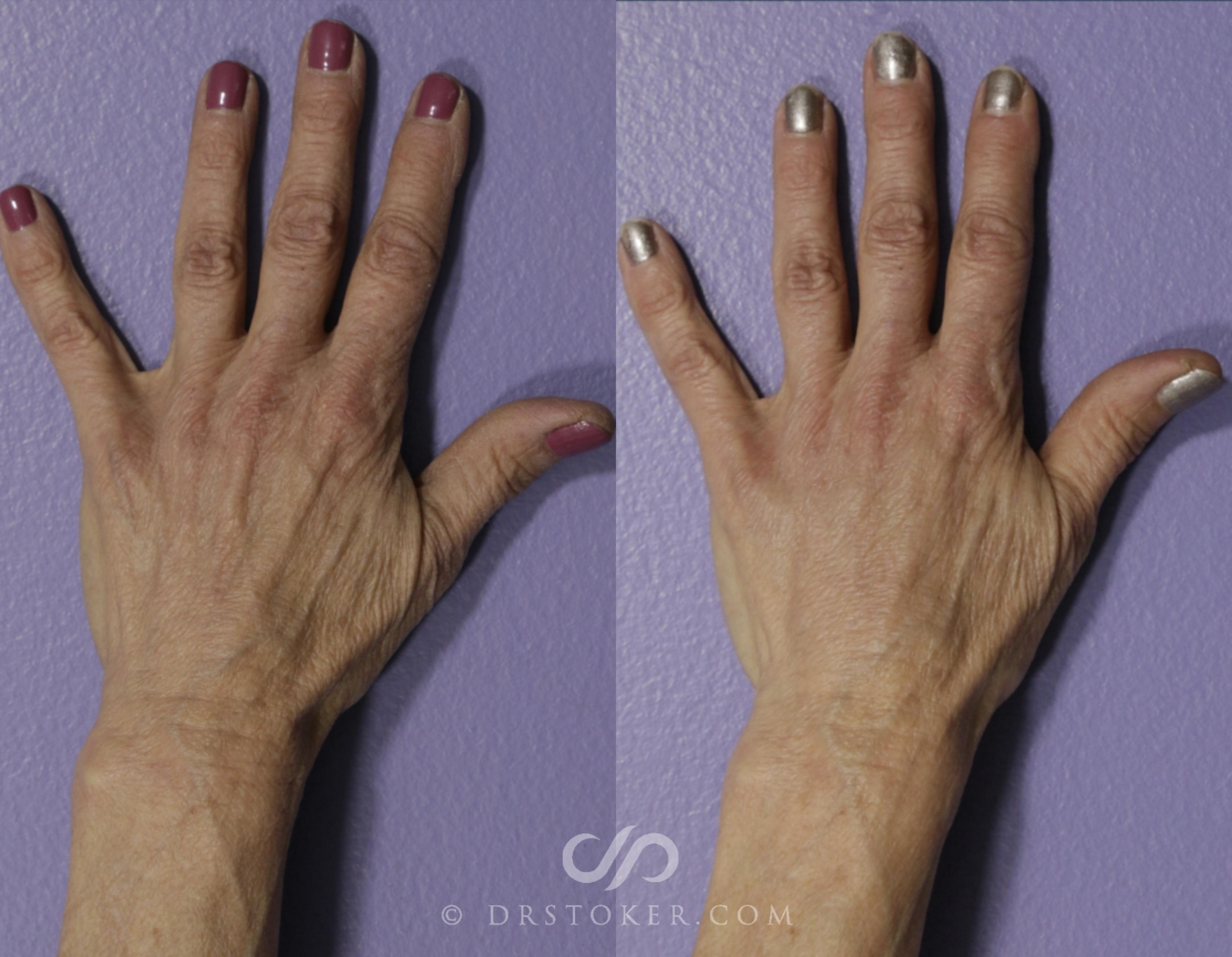 Before & After Hand Fillers Case 2277 Left Oblique View in Los Angeles, CA