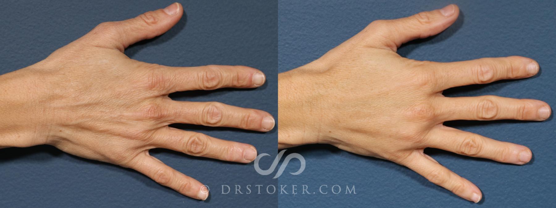 Before & After Hand Fillers Case 2701 Right Side View in Los Angeles, CA