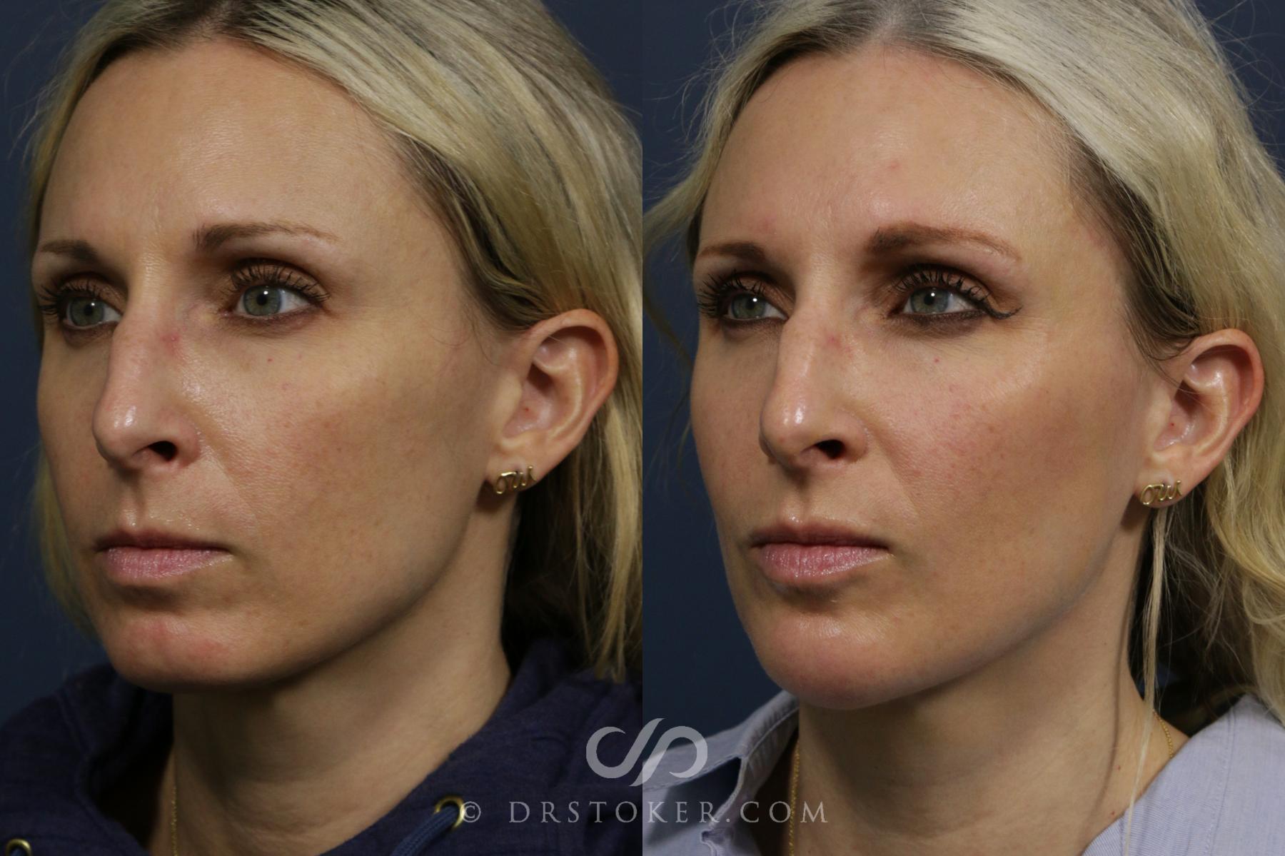 Before & After Injectables (Overview) Case 2098 Left Oblique View in Los Angeles, CA
