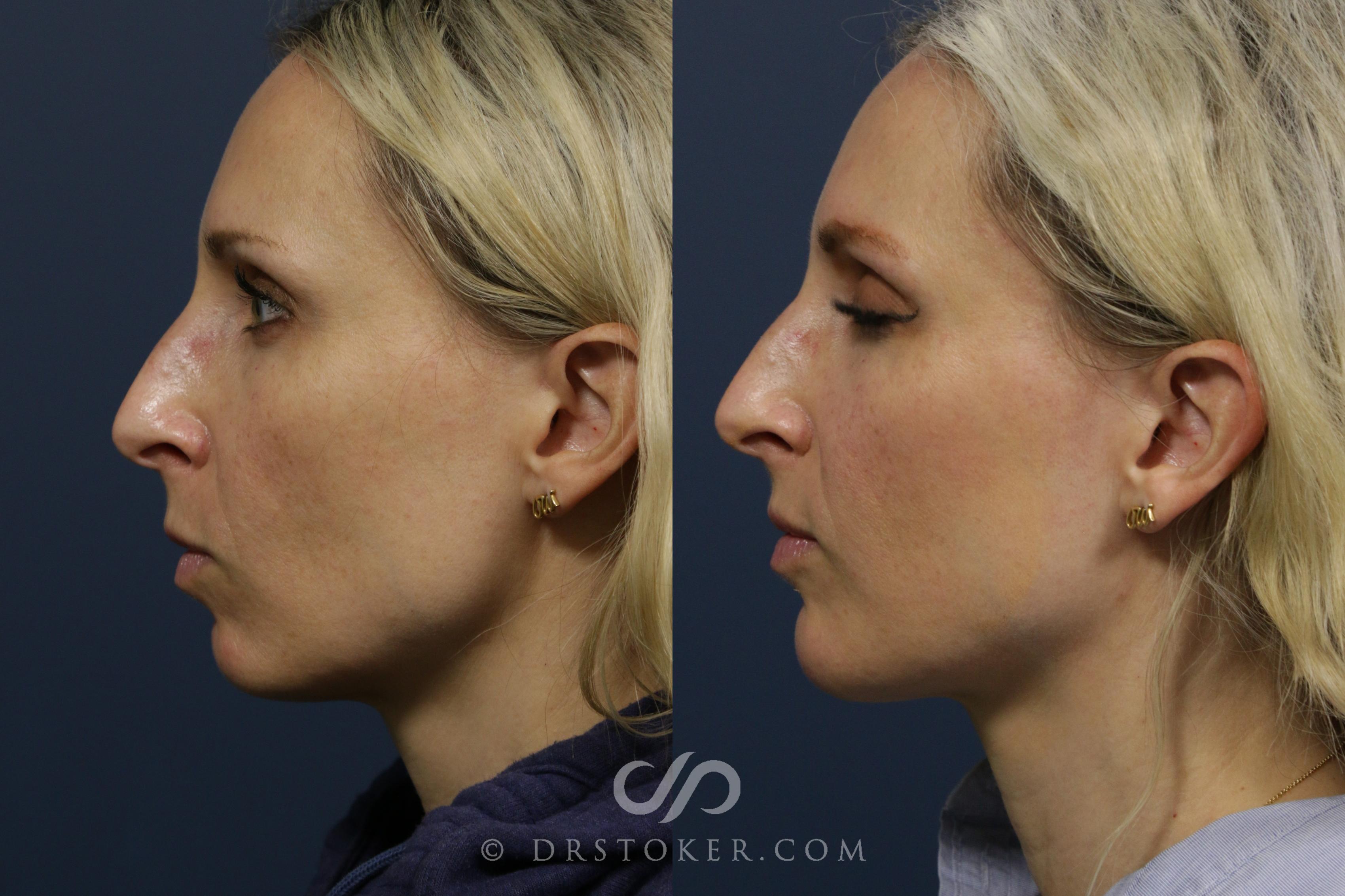 Before & After Injectables (Overview) Case 2098 Left Side View in Los Angeles, CA