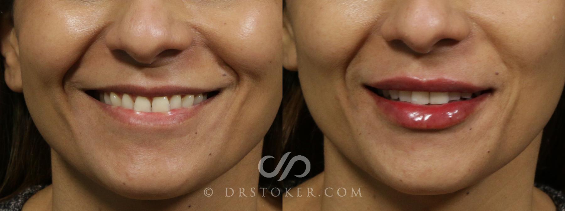 Before & After Injectables (Overview) Case 2099 Front smile View in Los Angeles, CA