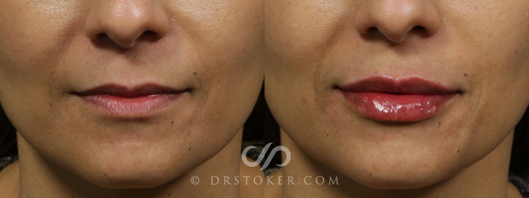 Before & After Injectables (Overview) Case 2099 Front View in Los Angeles, CA