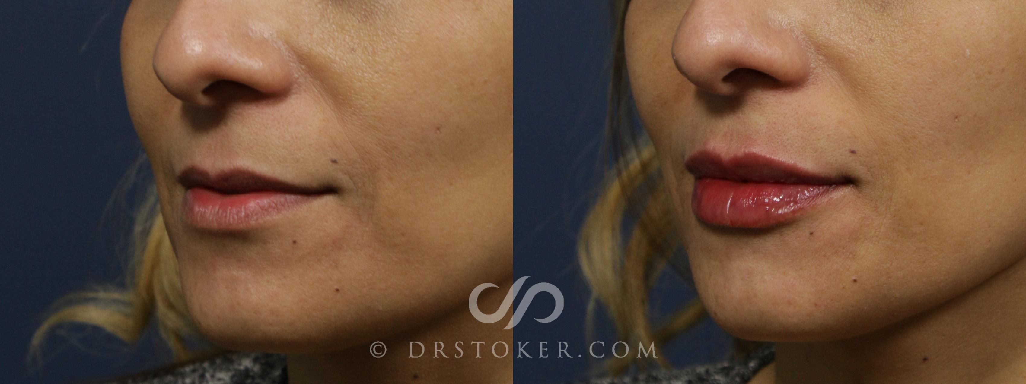 Before & After Injectables (Overview) Case 2099 Left Oblique View in Los Angeles, CA