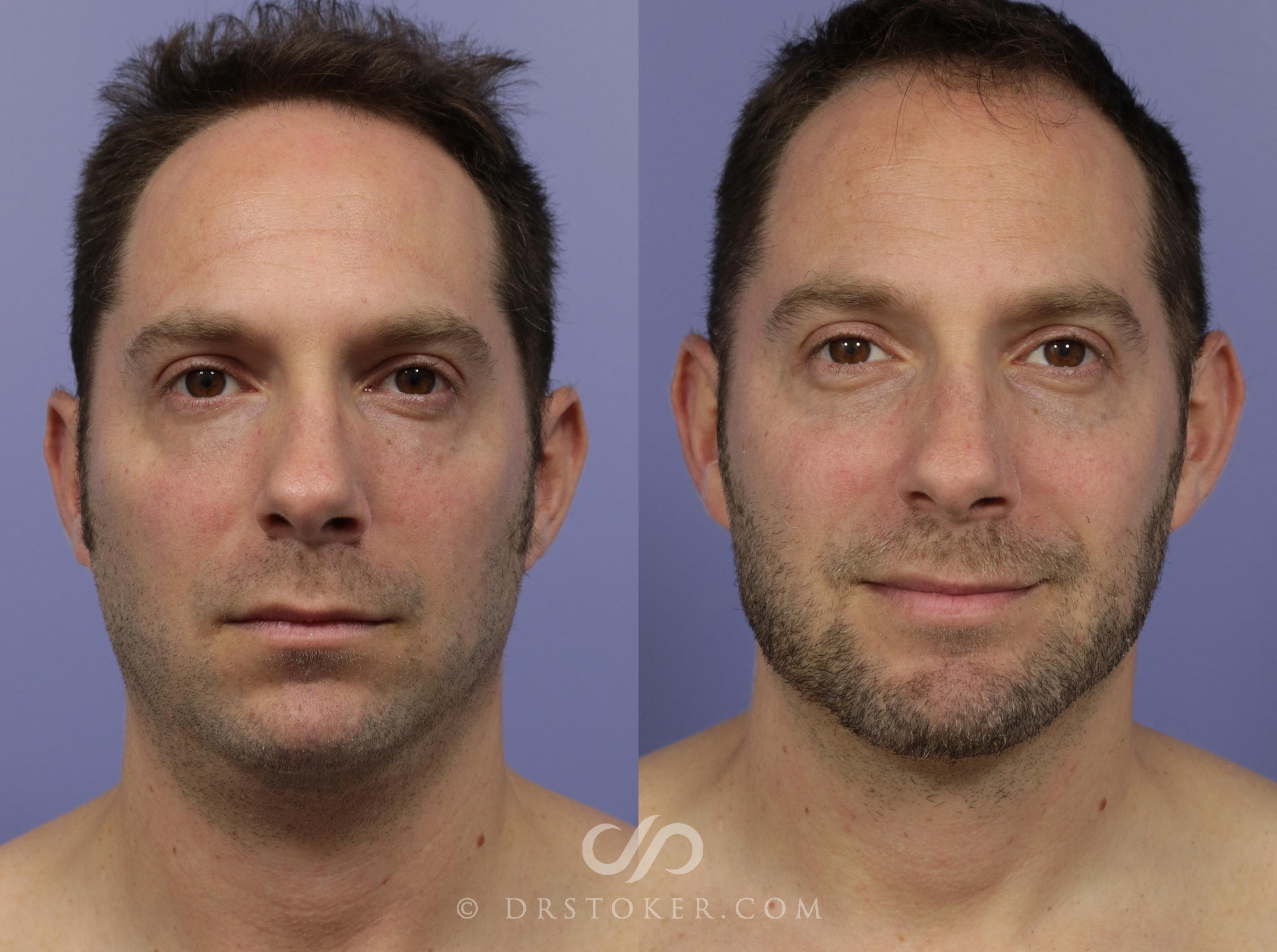 Before & After Injectables (Overview) Case 2101 Front View in Los Angeles, CA