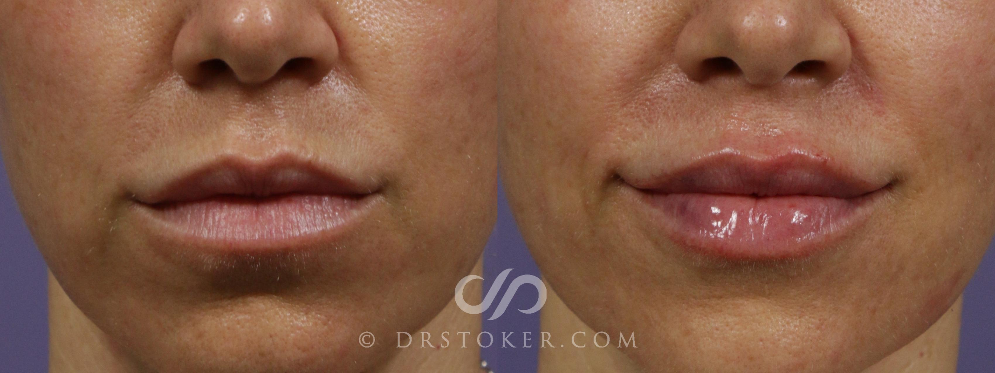 Before & After Injectables (Overview) Case 2102 Front View in Los Angeles, CA