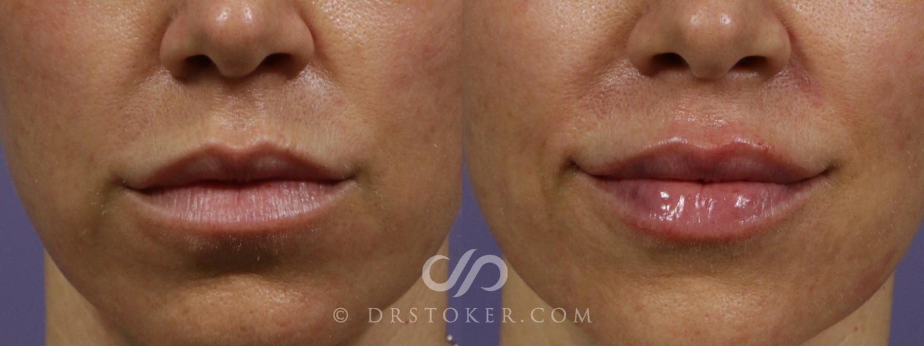 Before & After Lip Fillers/Augmentation Case 2102 Front View in Los Angeles, CA