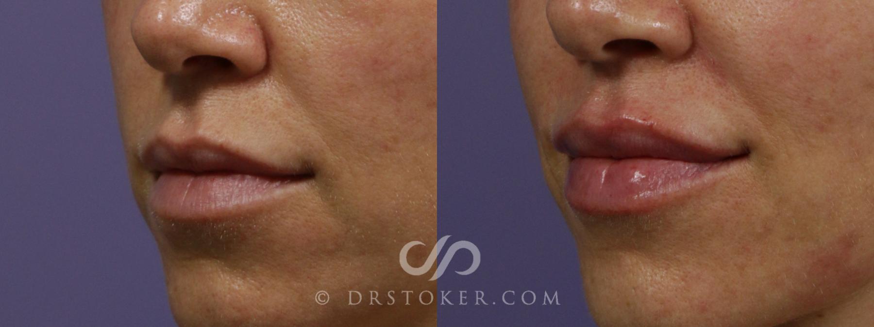 Before & After Facial Fillers Case 2102 Left Oblique View in Los Angeles, CA