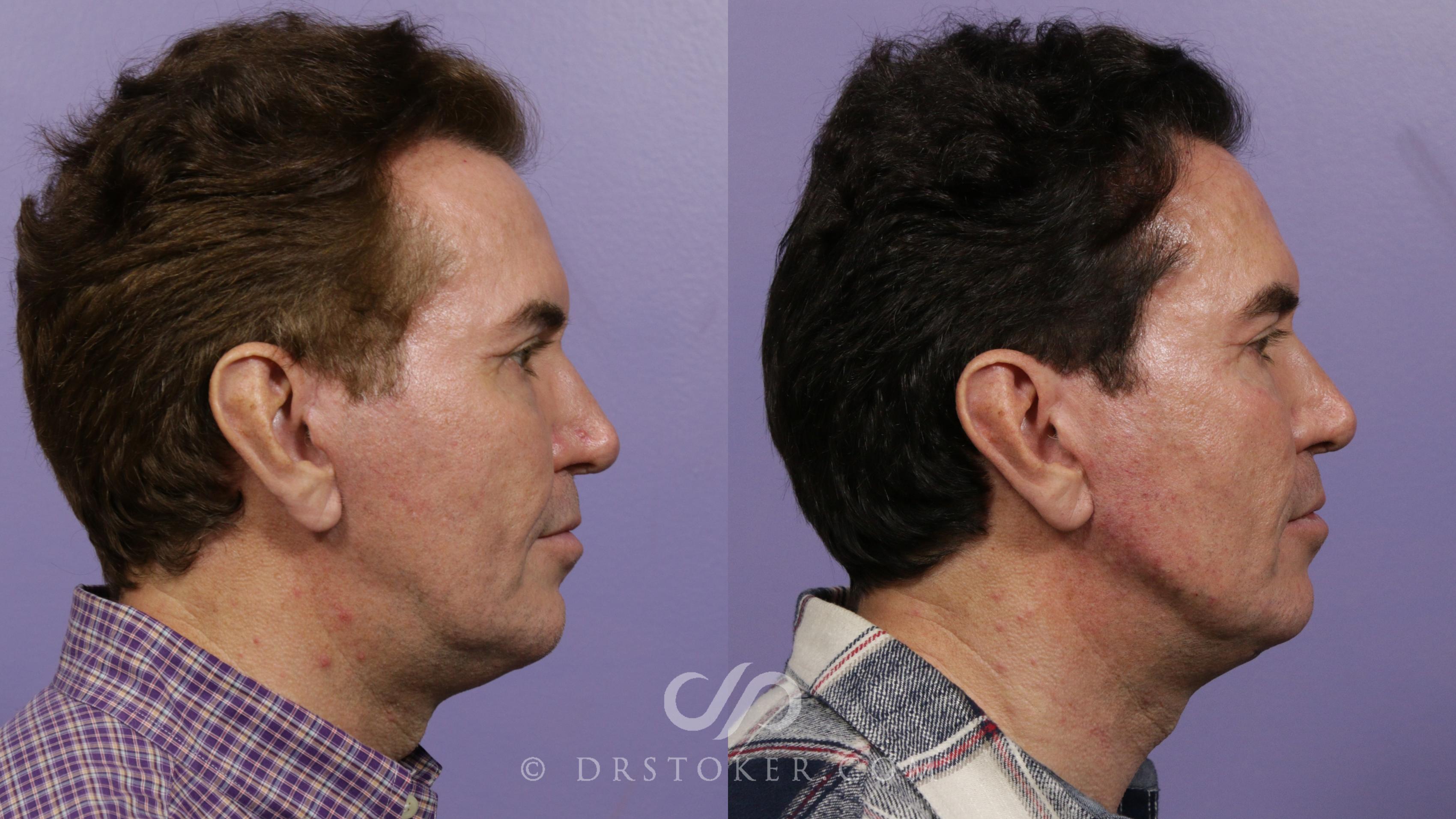 Before & After Injectables (Overview) Case 2112 Right Side View in Los Angeles, CA