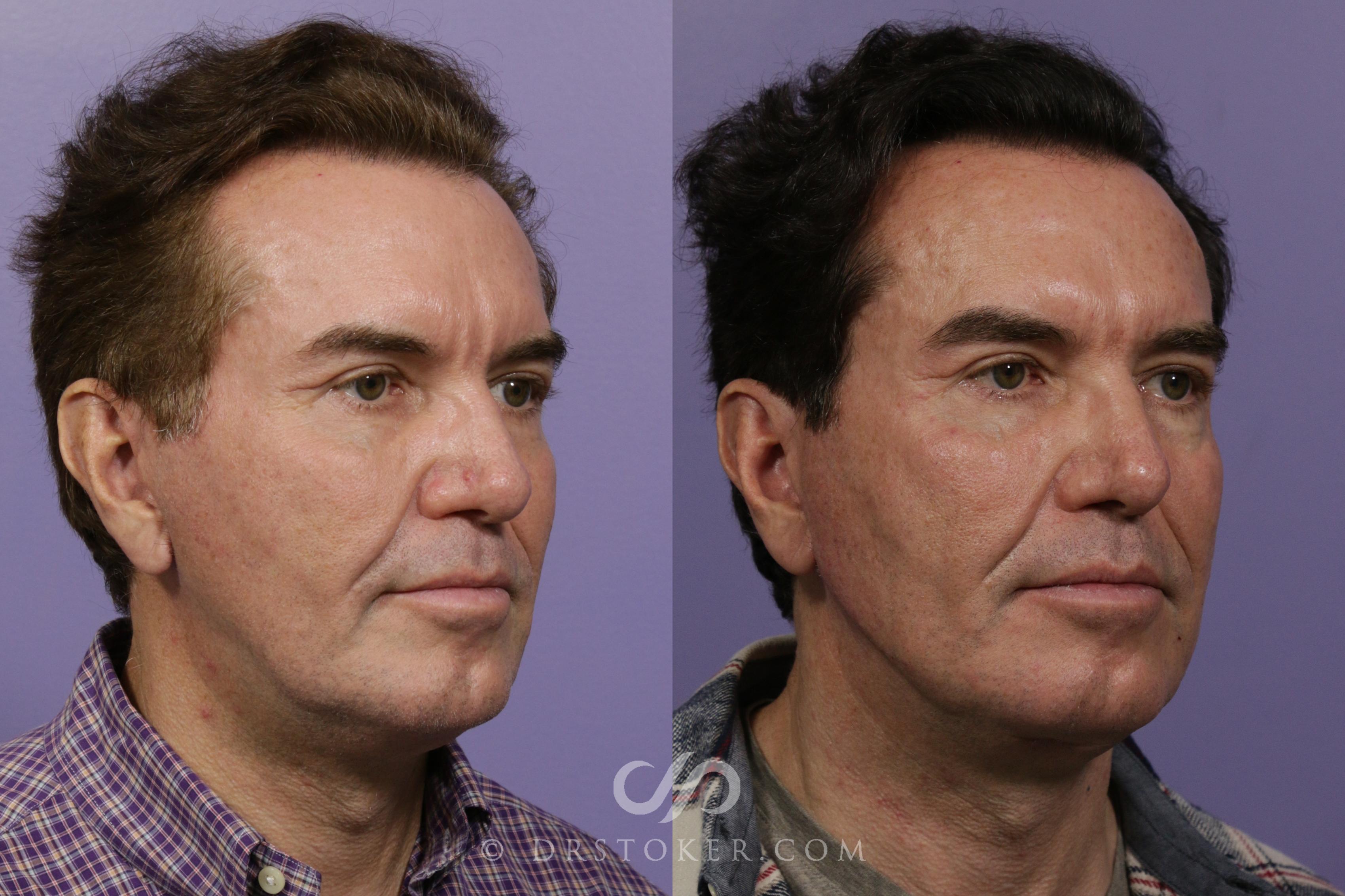 Before & After Injectables (Overview) Case 2113 Right Oblique View in Los Angeles, CA