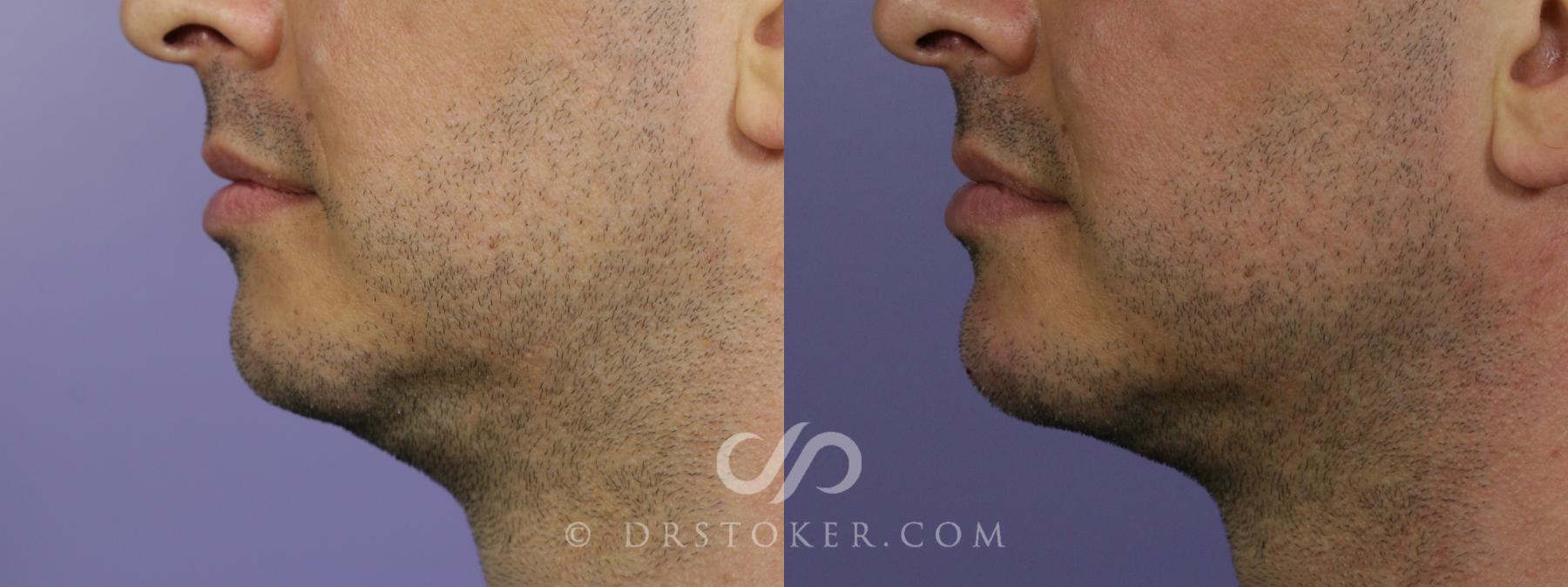 Before & After Injectables (Overview) Case 2114 Left Side View in Los Angeles, CA