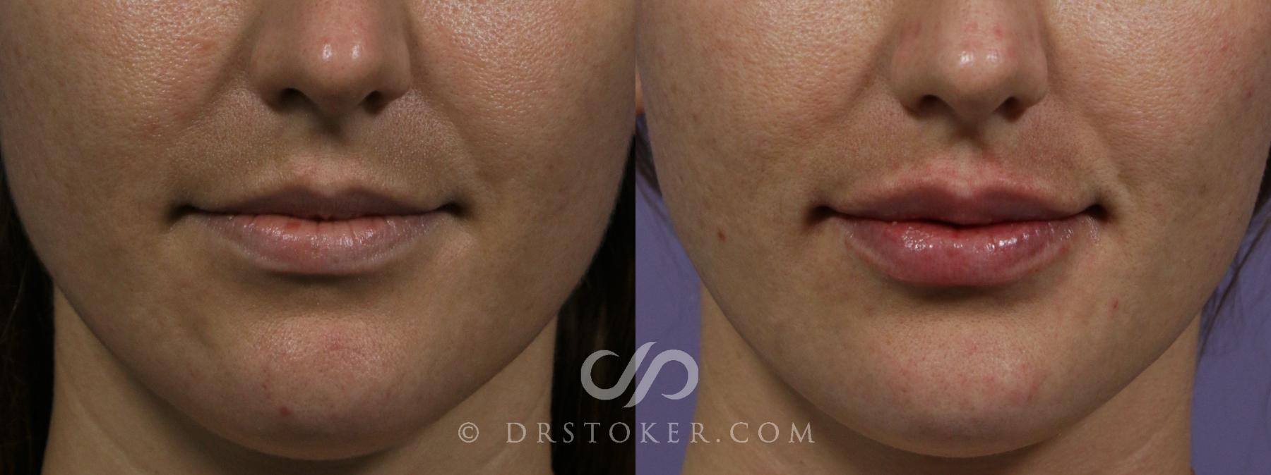 Before & After Injectables (Overview) Case 2115 Front View in Los Angeles, CA