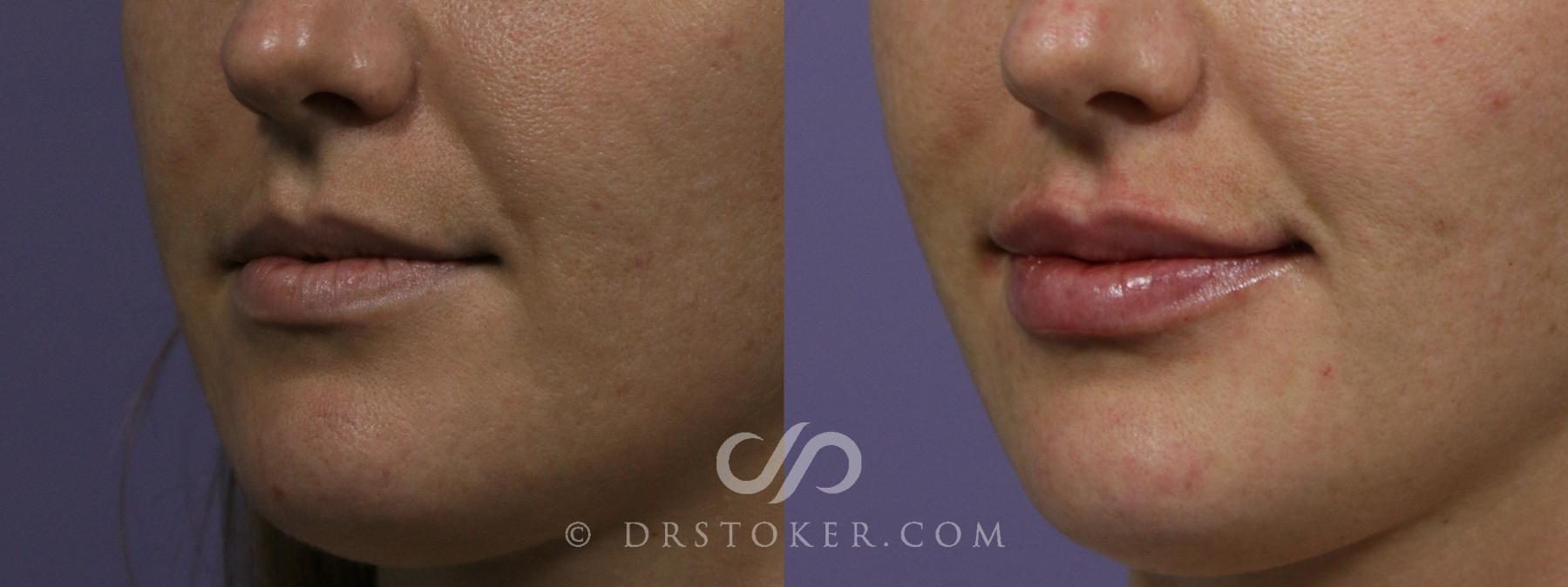Before & After Injectables (Overview) Case 2116 Right Oblique View in Los Angeles, CA