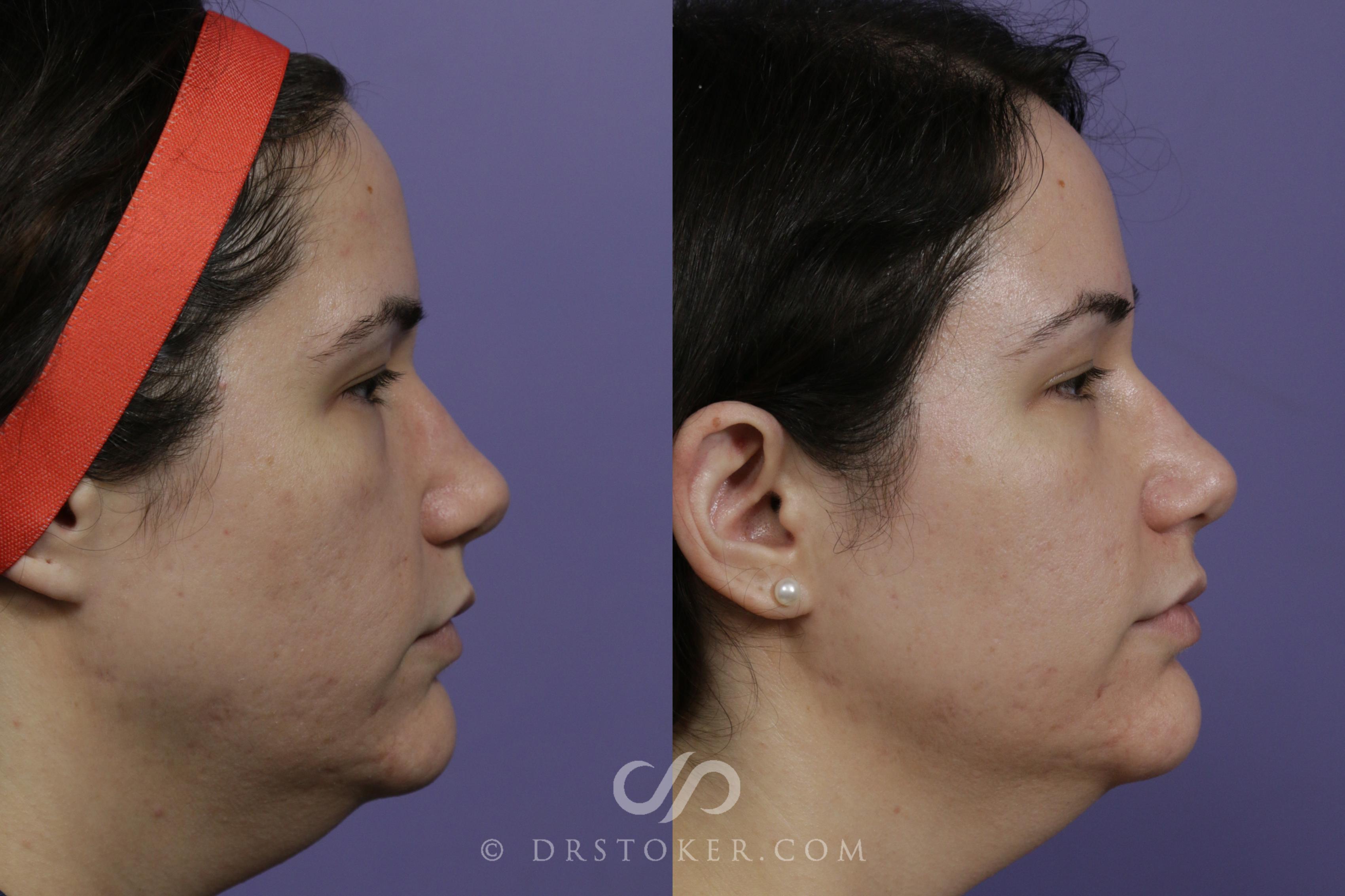 Before & After Jawline Fillers Case 1599 View #1 View in Los Angeles, CA