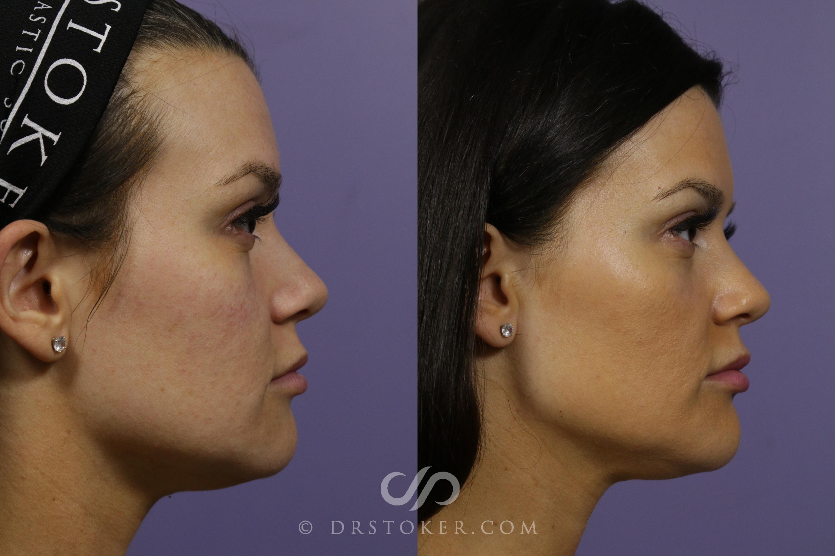 Before & After Injectables (Overview) Case 1644 View #1 View in Los Angeles, CA