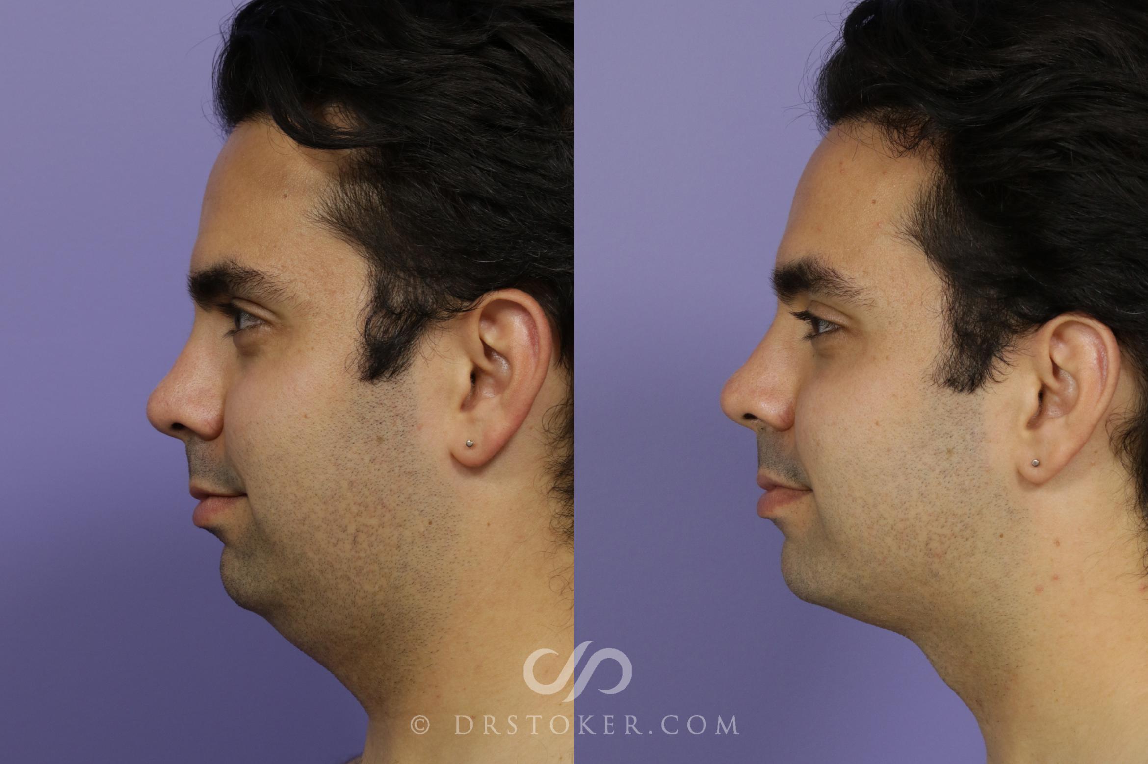 Before & After KYBELLA® Double Chin Treatment Case 1589 View #1 View in Los Angeles, CA