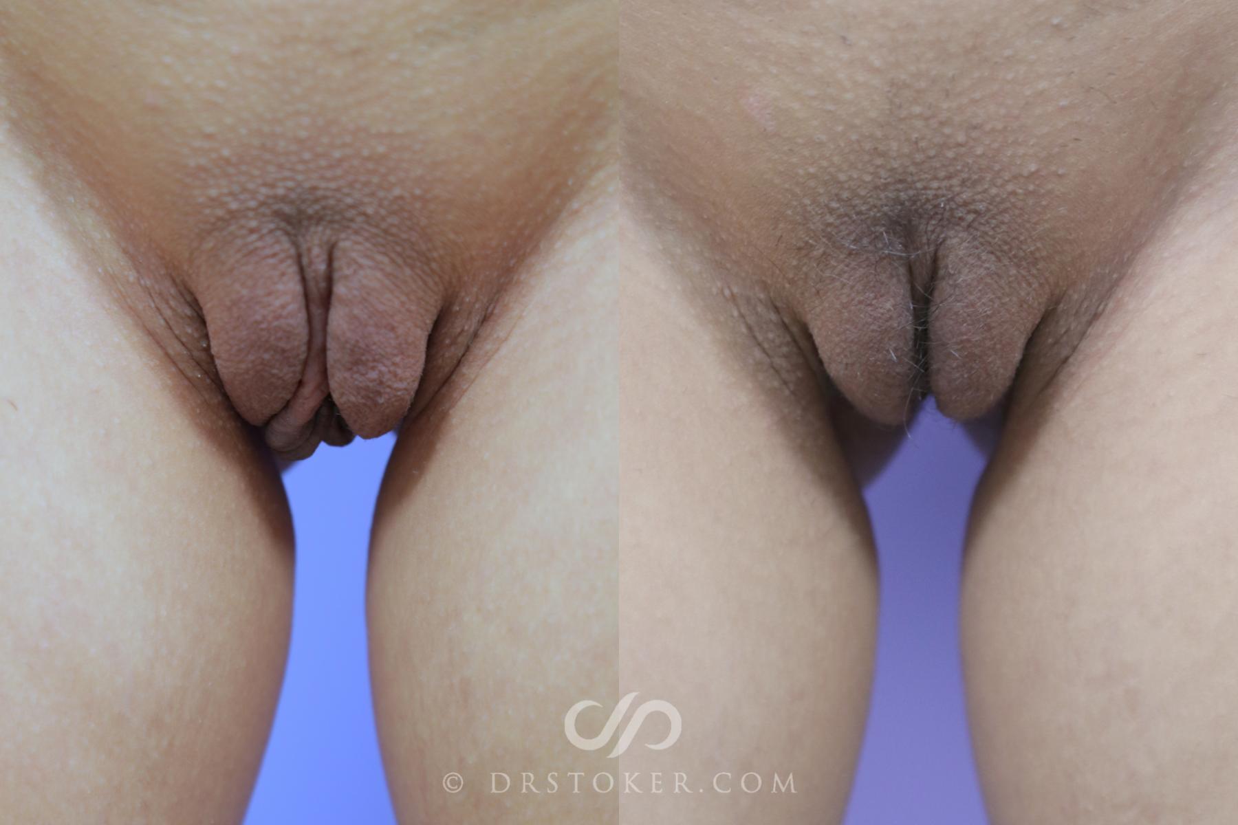 Before & After Labiaplasty - Labia Majora Reduction Case 1477 View #1 View in Los Angeles, CA