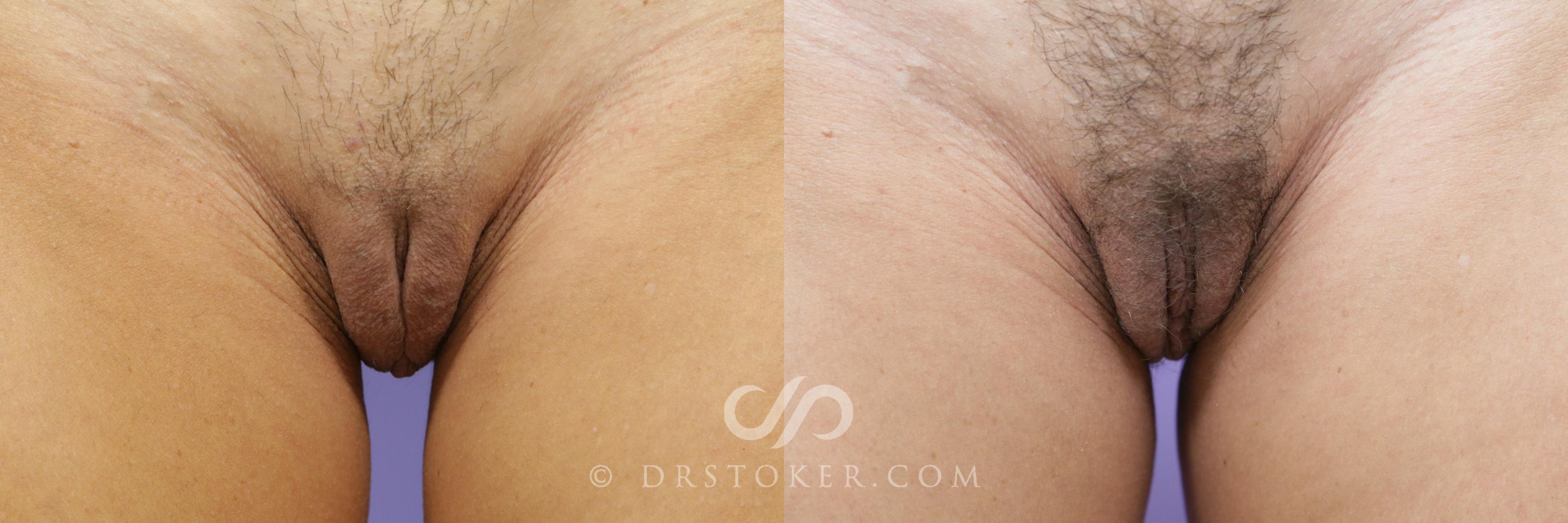 Before & After Labiaplasty Case 712 View #1 View in Los Angeles, CA