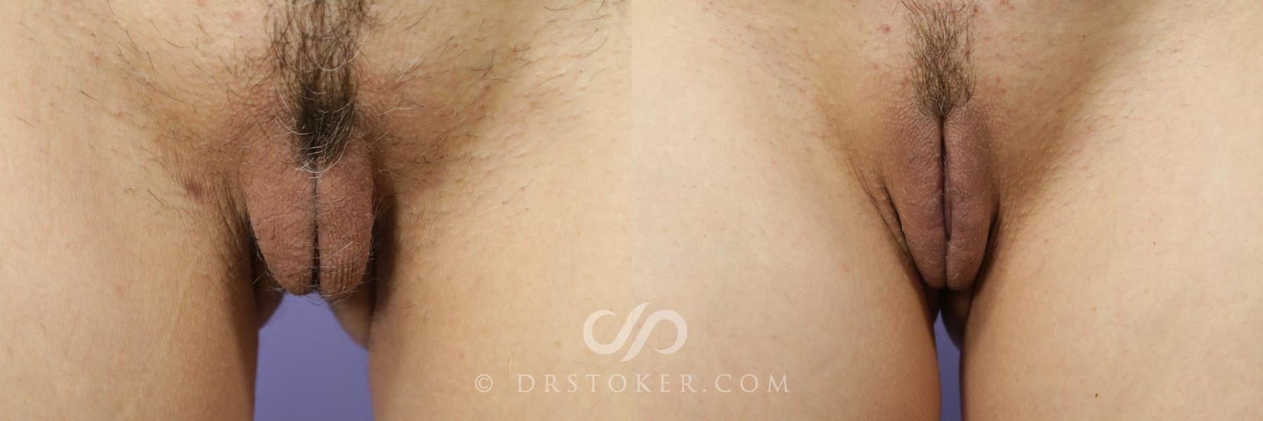Before & After Labiaplasty Case 714 View #1 View in Los Angeles, CA