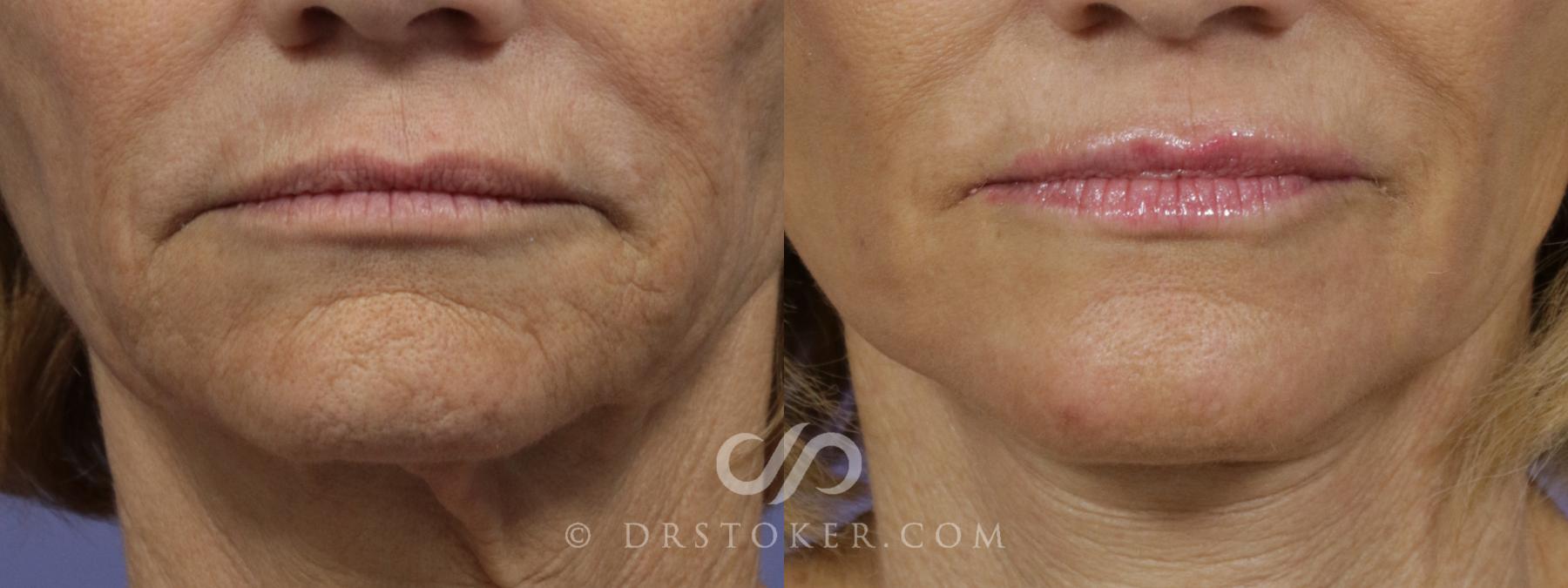 Before & After Laser Skin Resurfacing Case 1444 View #1 View in Los Angeles, CA
