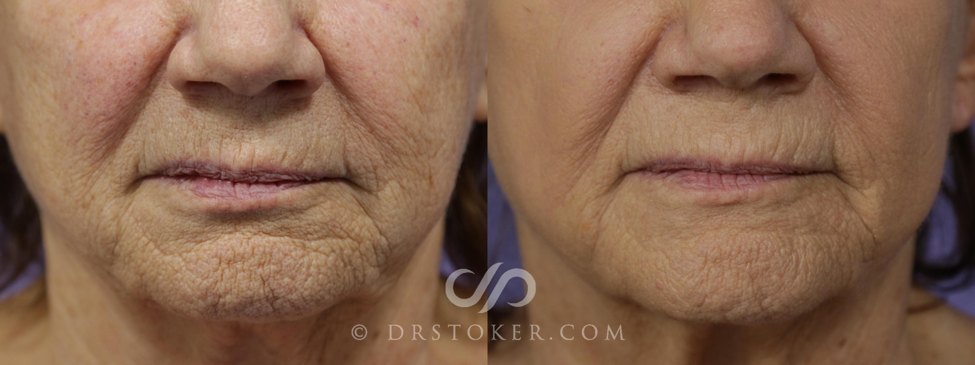 Before & After Laser Skin Resurfacing  Case 1532 View #1 View in Los Angeles, CA