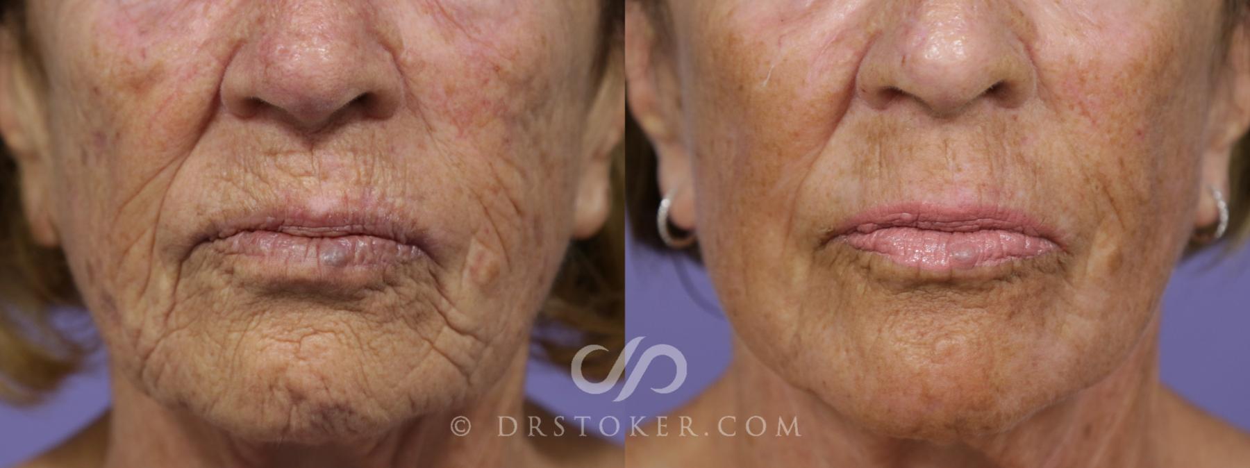 Before & After Laser Skin Resurfacing (Mouth) Case 1533 View #1 View in Los Angeles, CA