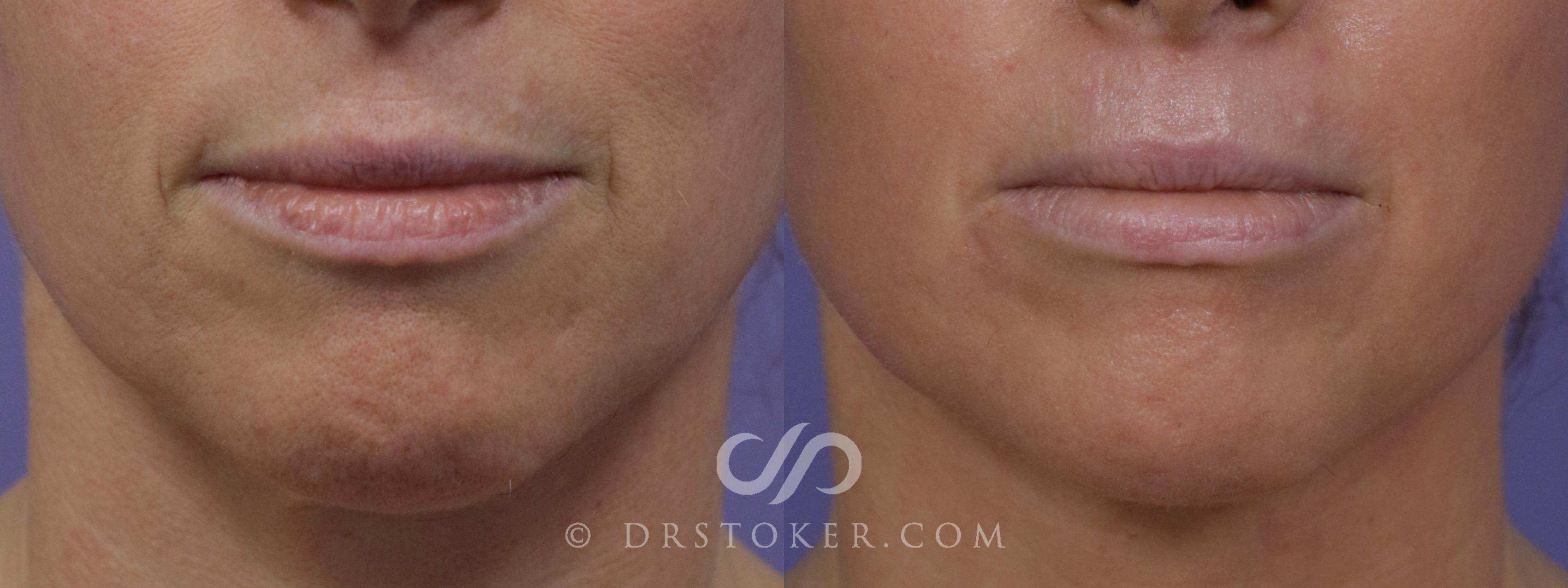 Before & After Laser Skin Resurfacing  Case 1551 View #1 View in Los Angeles, CA