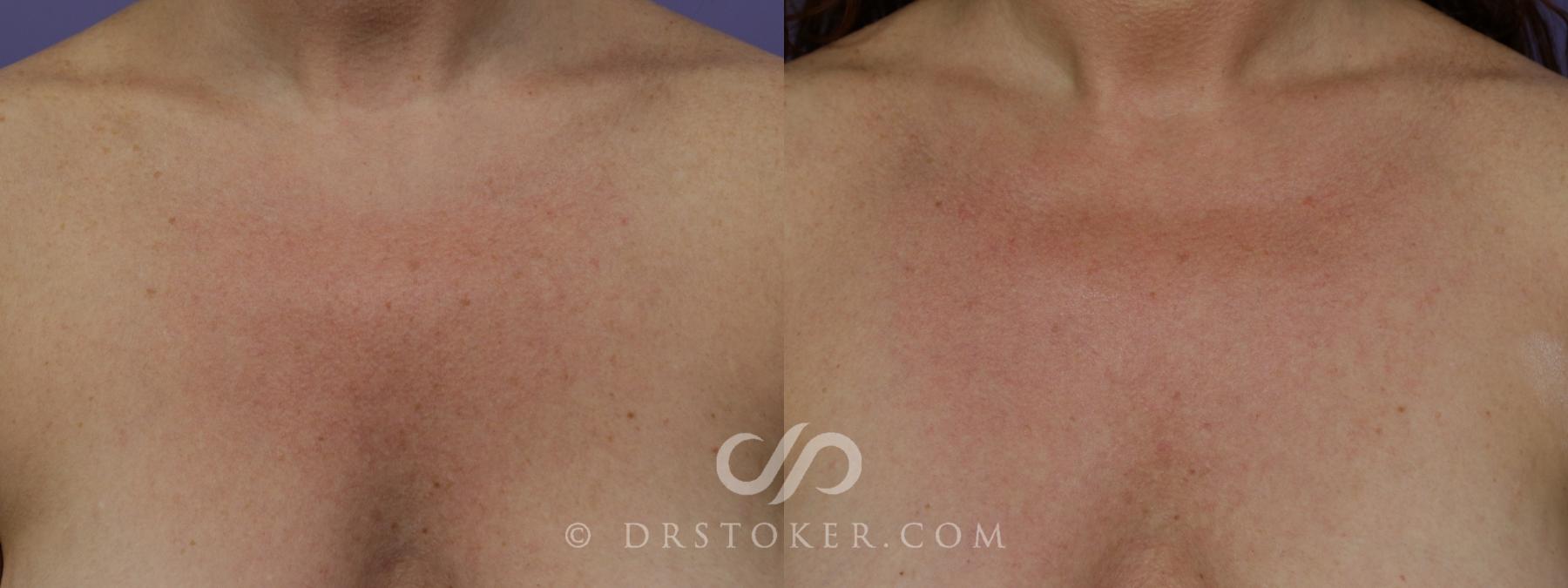 Before & After Laser Skin Resurfacing  Case 1552 View #1 View in Los Angeles, CA