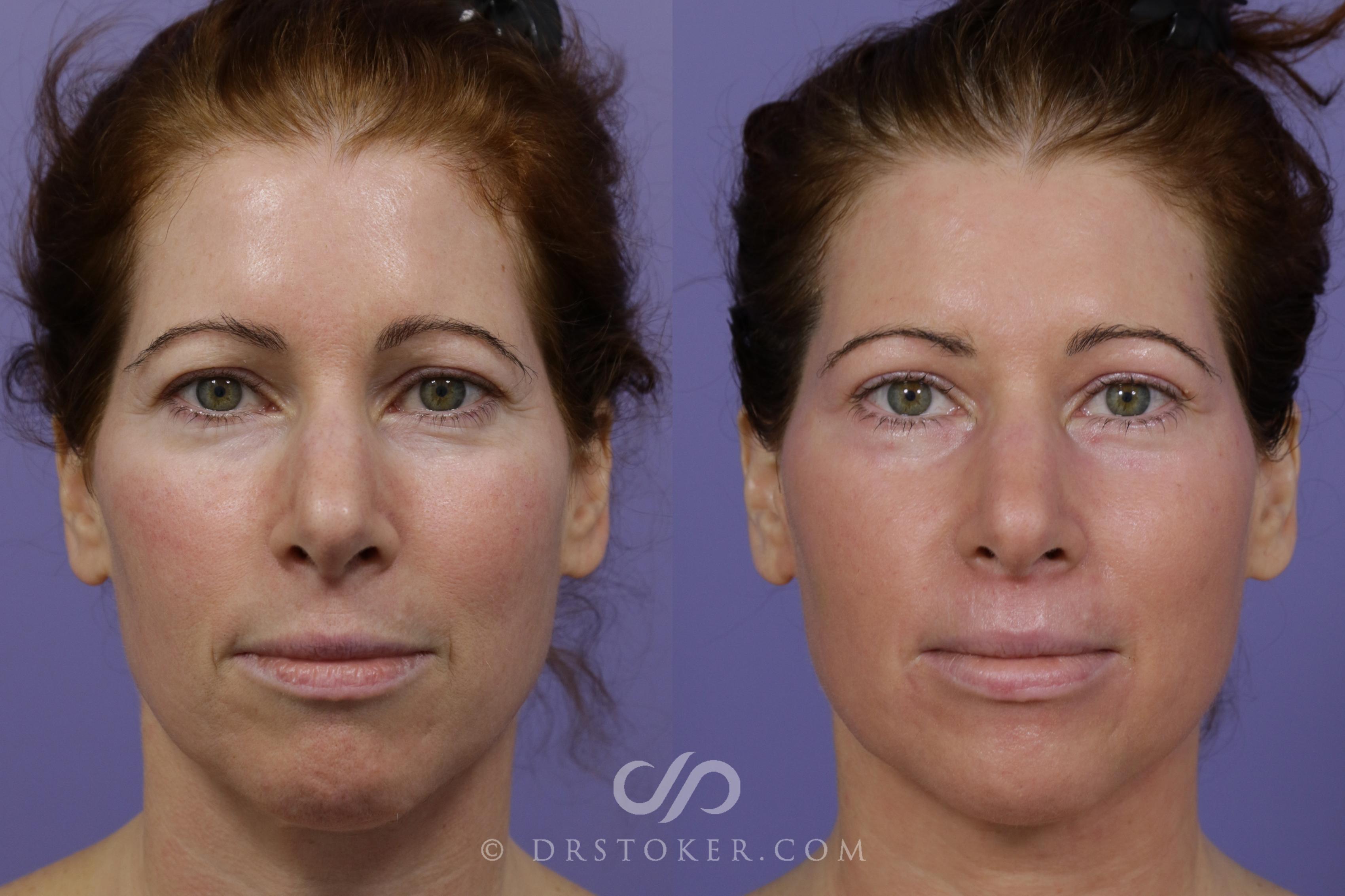 Before & After Laser Skin Resurfacing  Case 1553 View #1 View in Los Angeles, CA