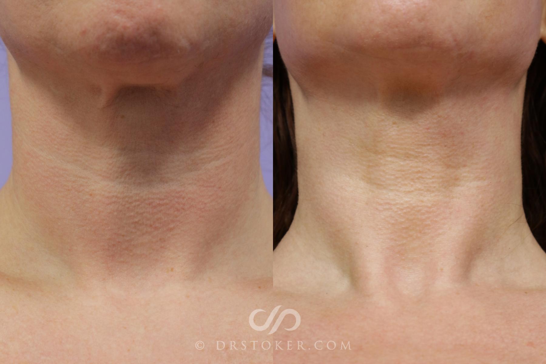 Before & After Laser Skin Resurfacing  Case 1554 View #1 View in Los Angeles, CA