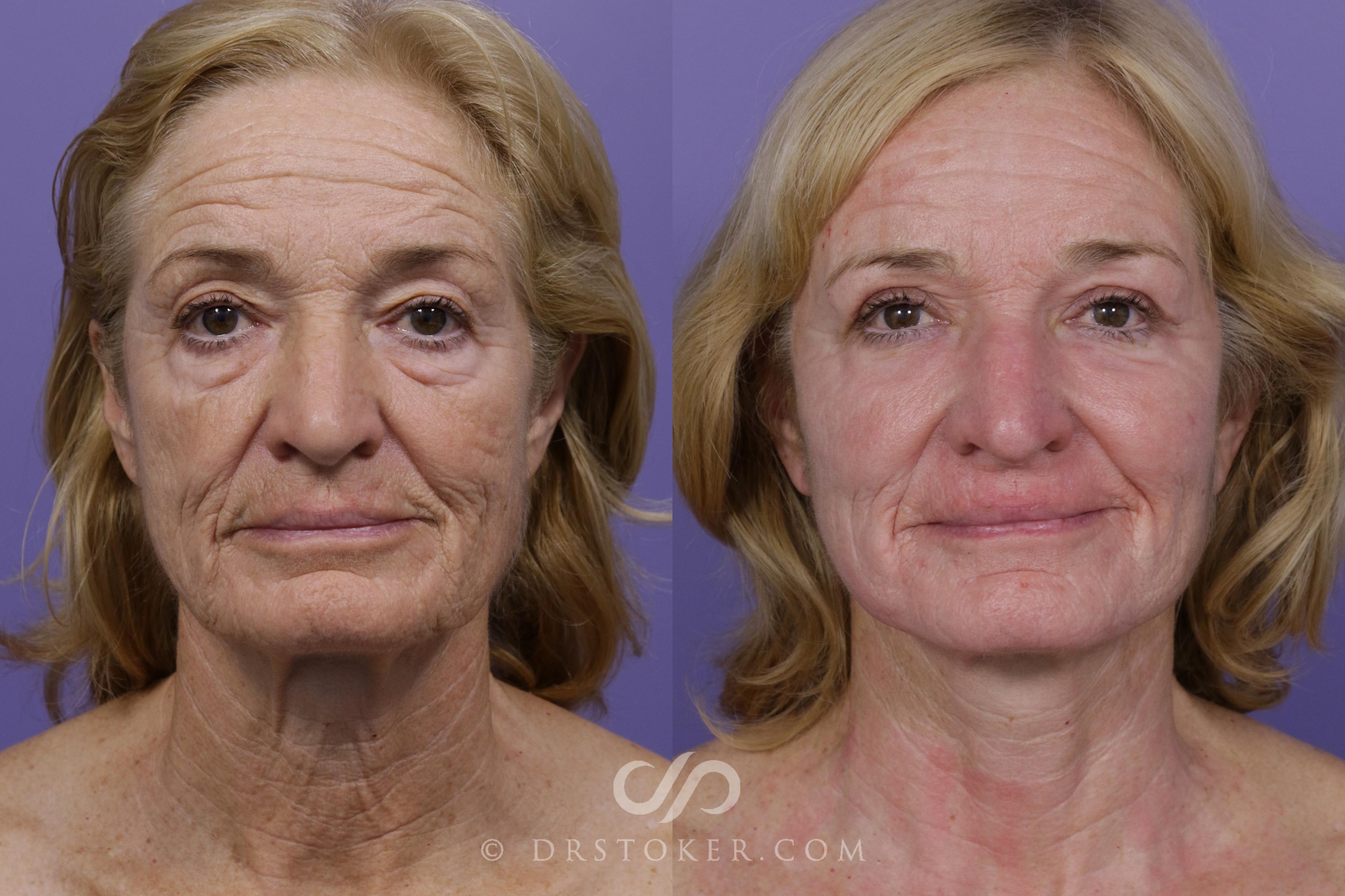 Before & After Necklift Case 1773 View #1 View in Los Angeles, CA