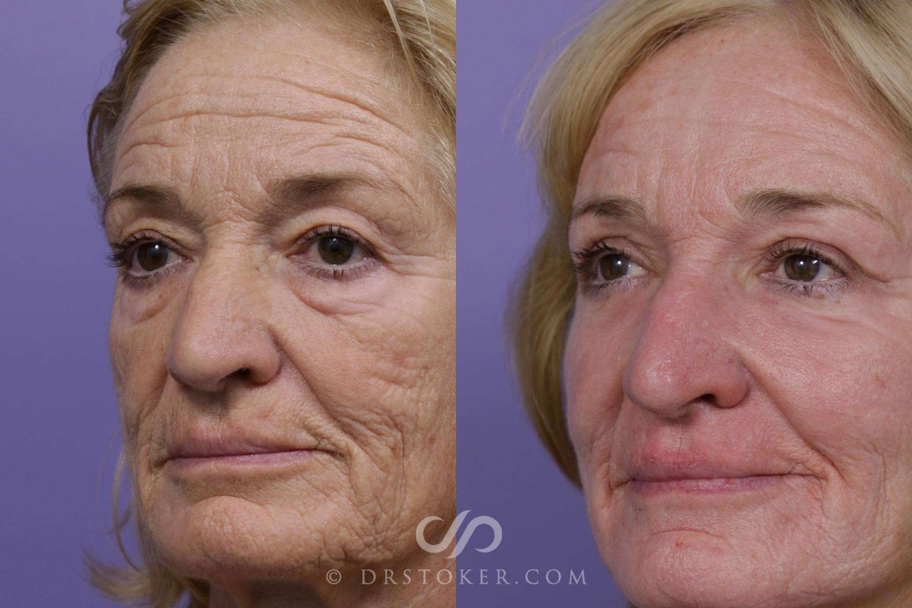 Before & After Laser Skin Resurfacing  Case 1773 View #2 View in Los Angeles, CA