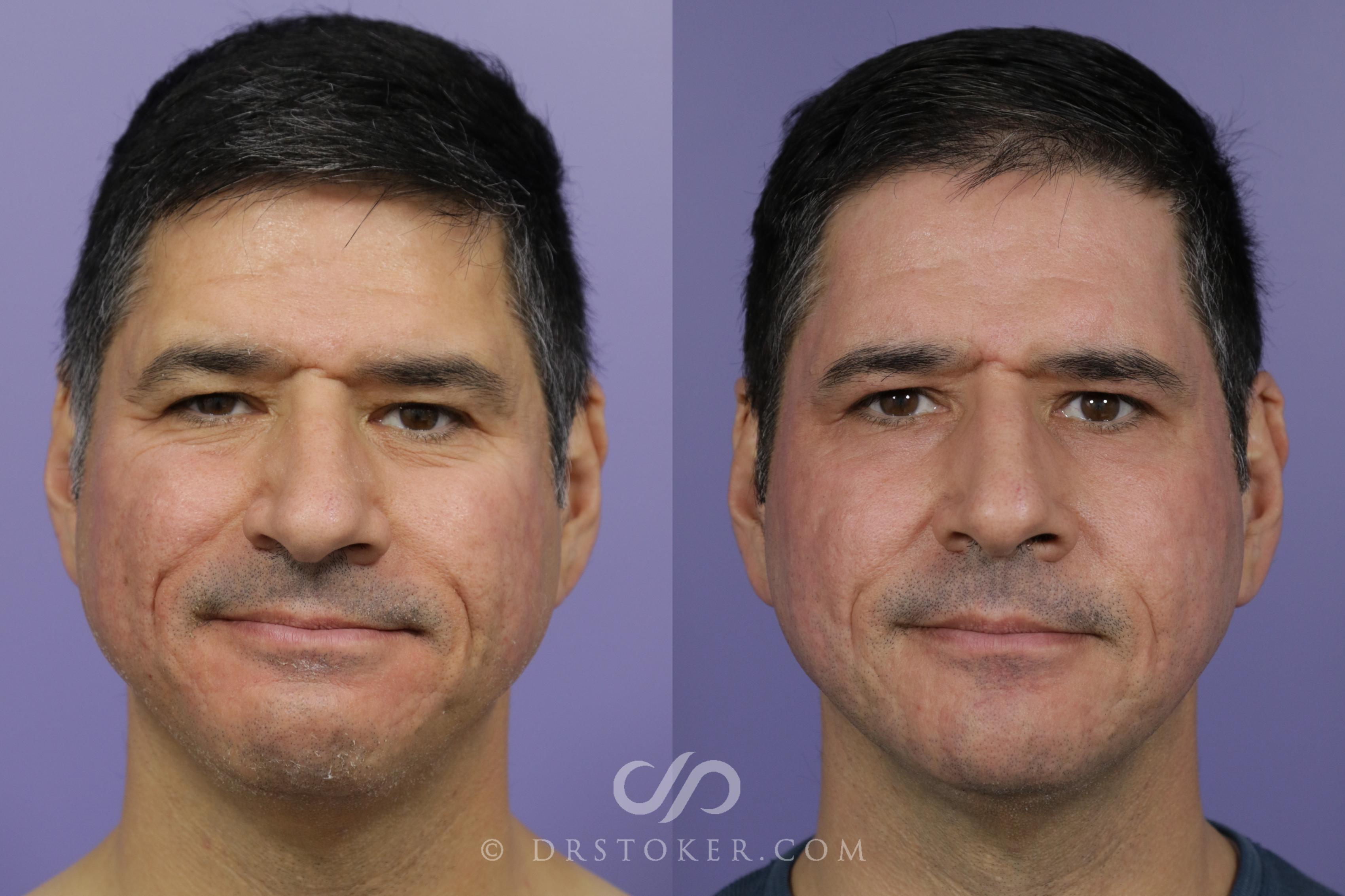 Before & After Laser Skin Resurfacing  Case 1778 View #1 View in Los Angeles, CA