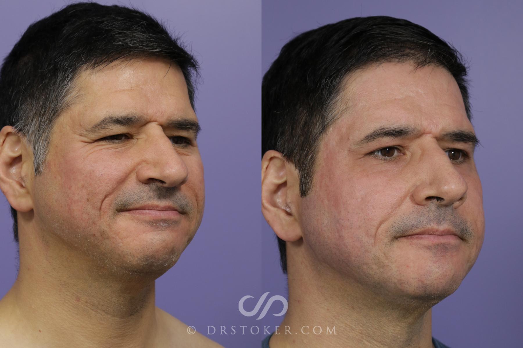 Before & After Laser Skin Resurfacing  Case 1778 View #2 View in Los Angeles, CA