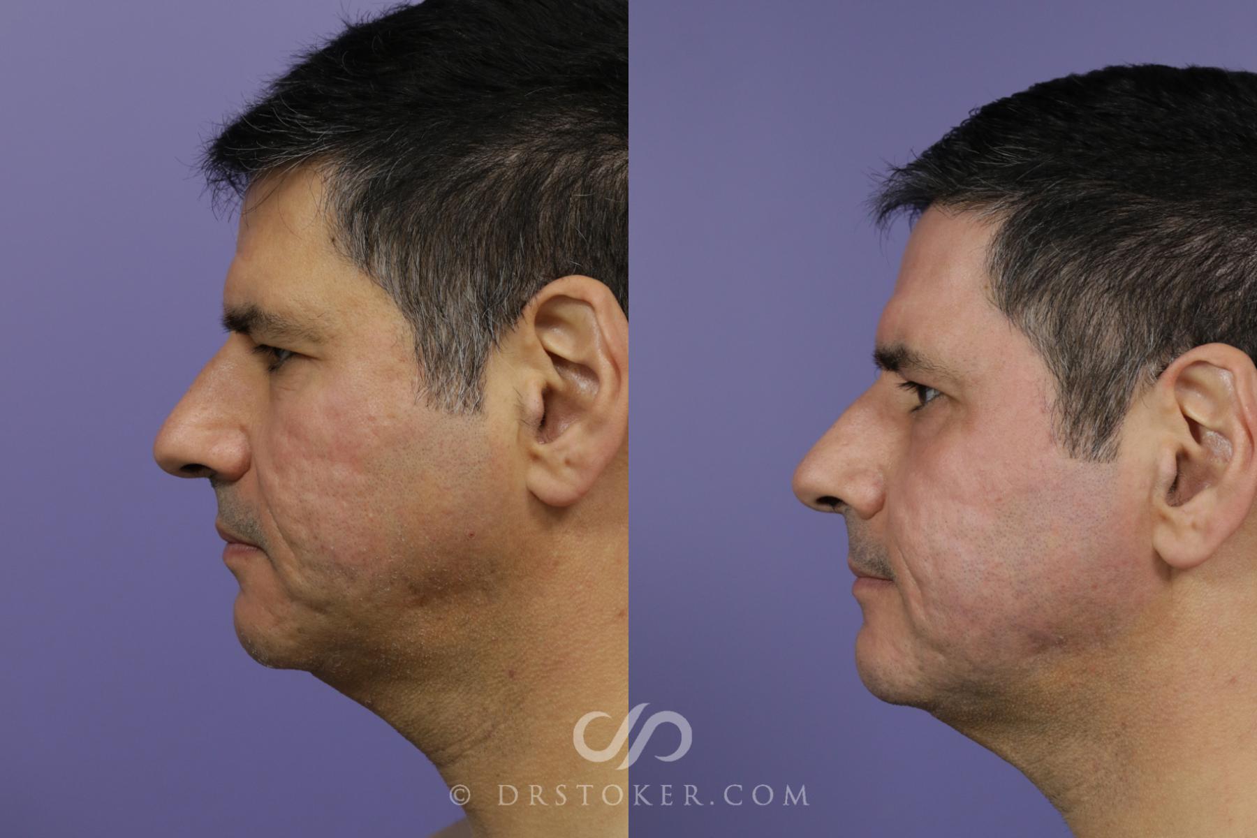 Before & After Laser Skin Resurfacing  Case 1778 View #3 View in Los Angeles, CA
