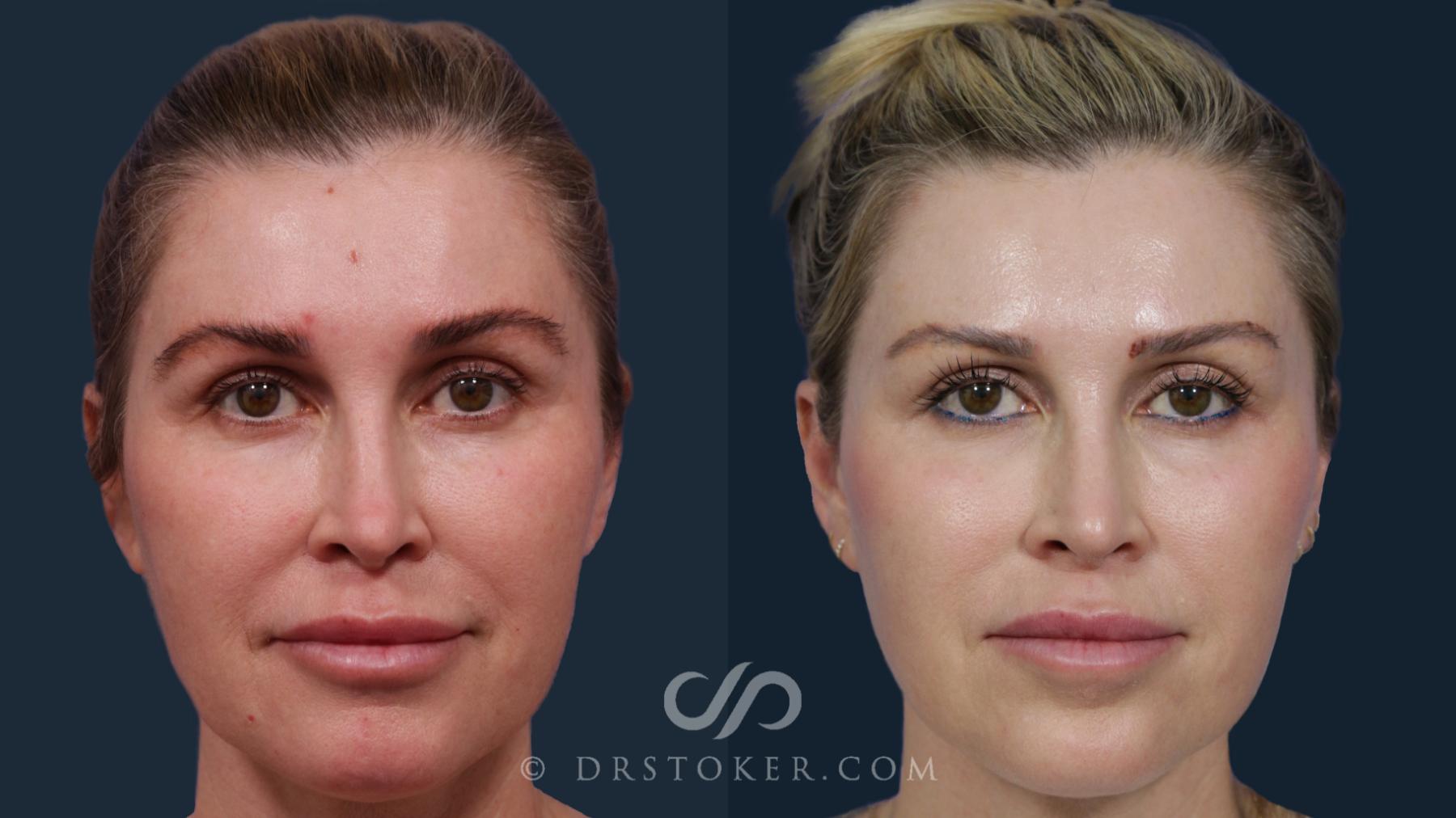 Before & After Laser Skin Resurfacing  Case 1800 Front View in Los Angeles, CA